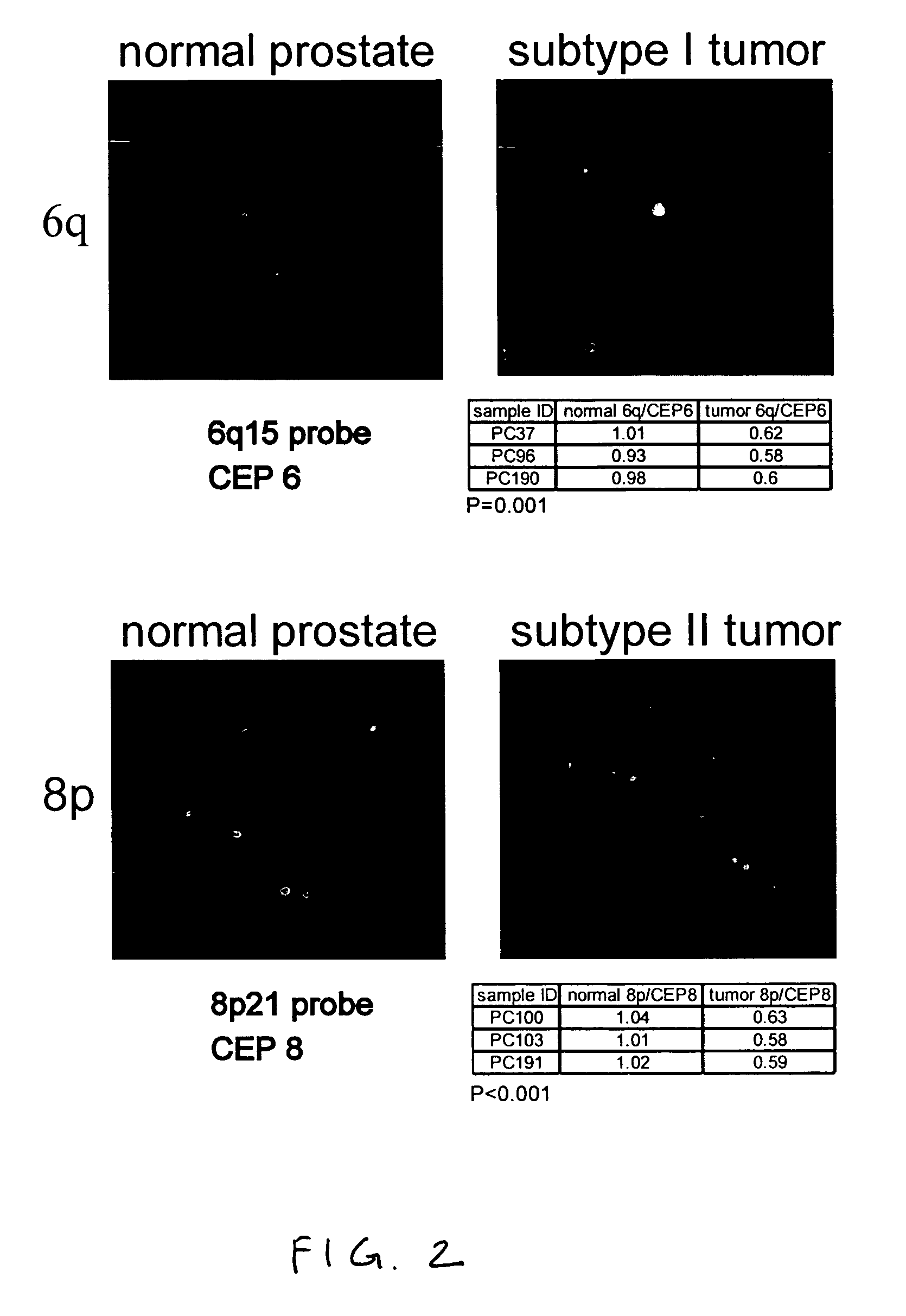 Markers of DNA copy number alteration for improved prognostication in prostate cancer