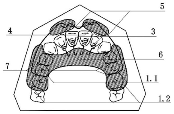 Maxillary occlusal pad-lip shield appliance