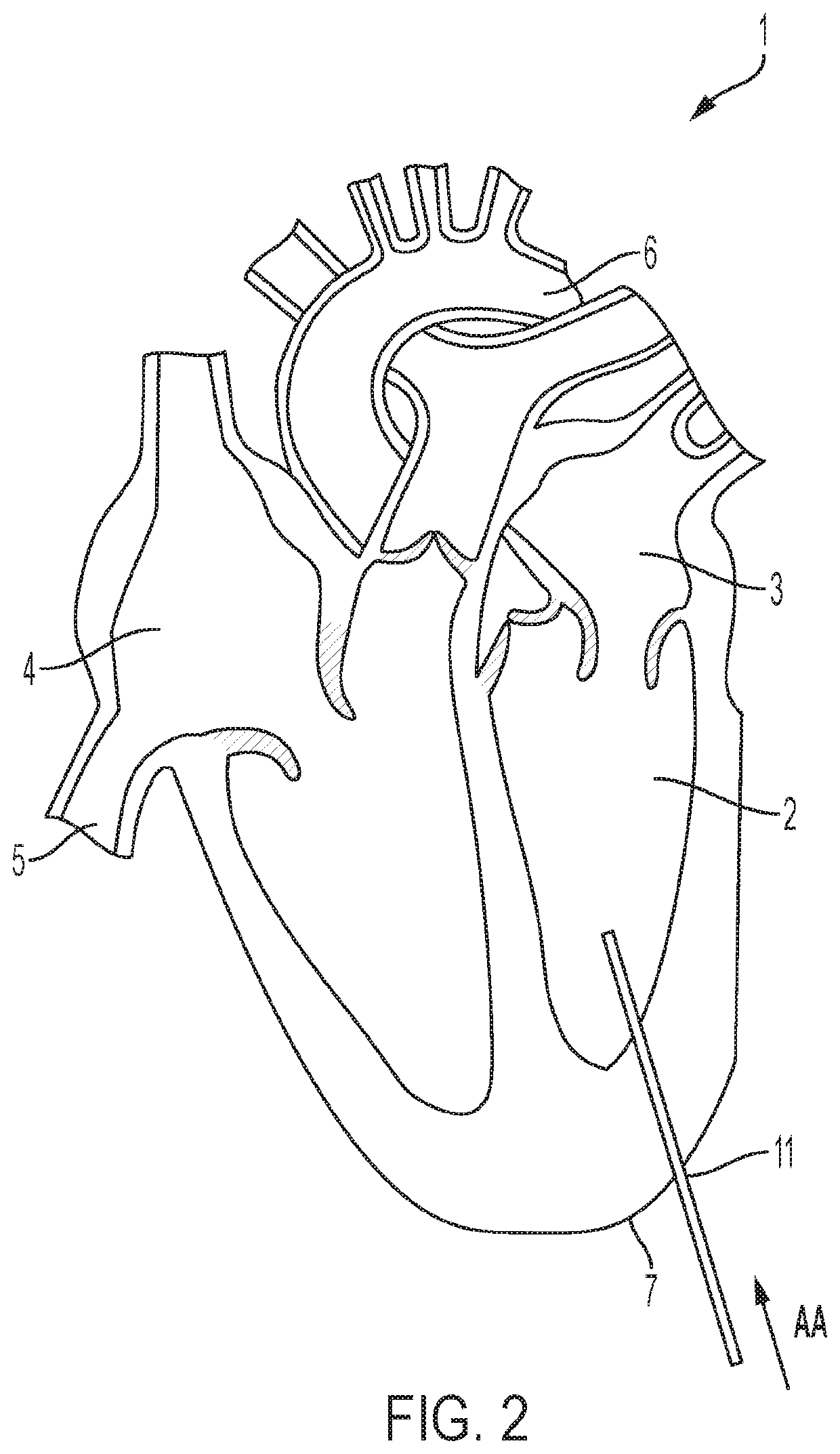 Apparatus And Methods For Delivery Of Prosthetic Heart Valves