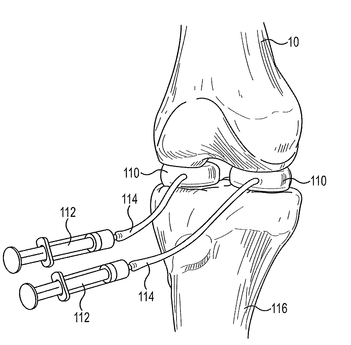 Modular apparatus and method for sculpting the surface of a joint