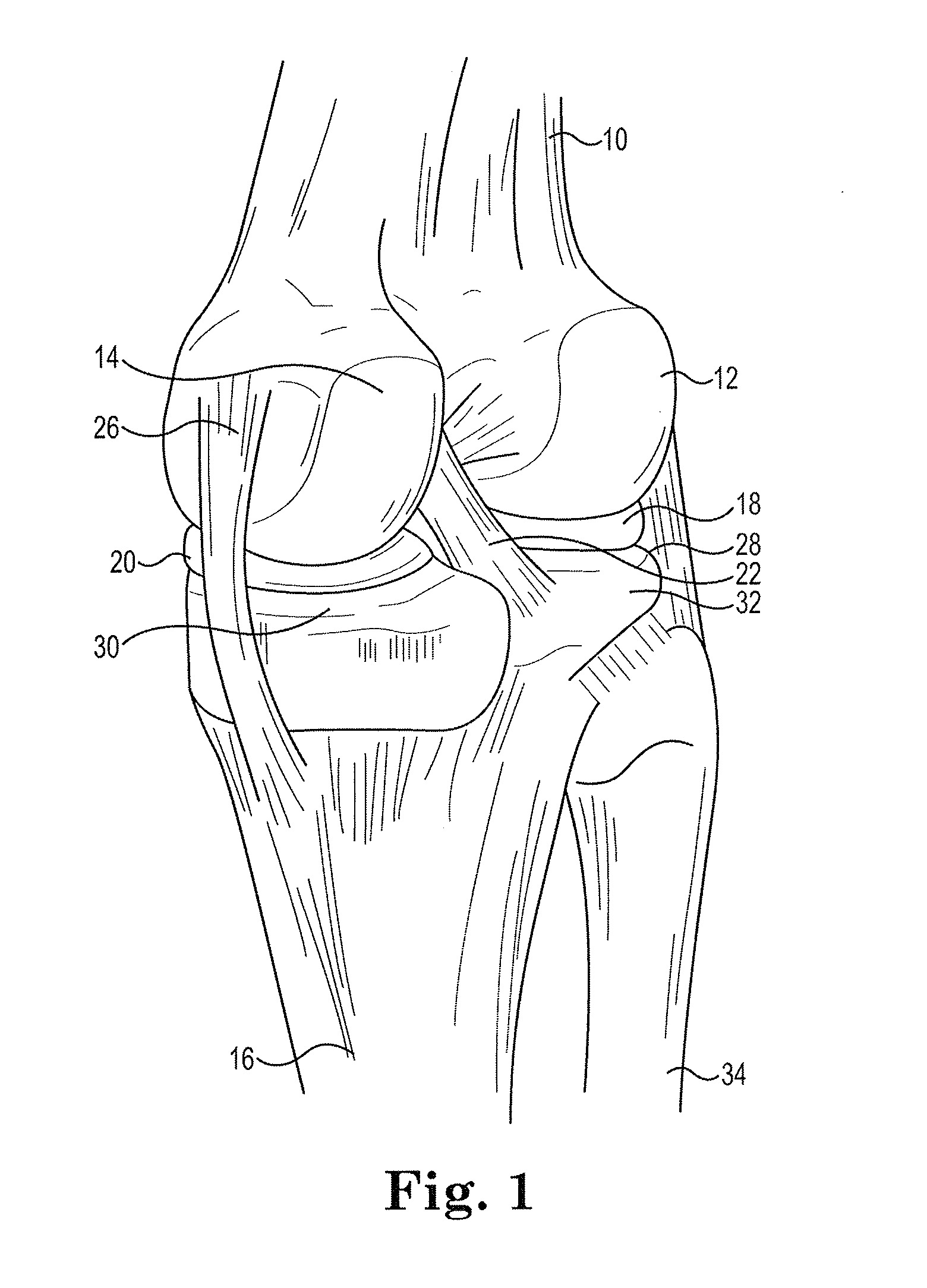 Modular apparatus and method for sculpting the surface of a joint