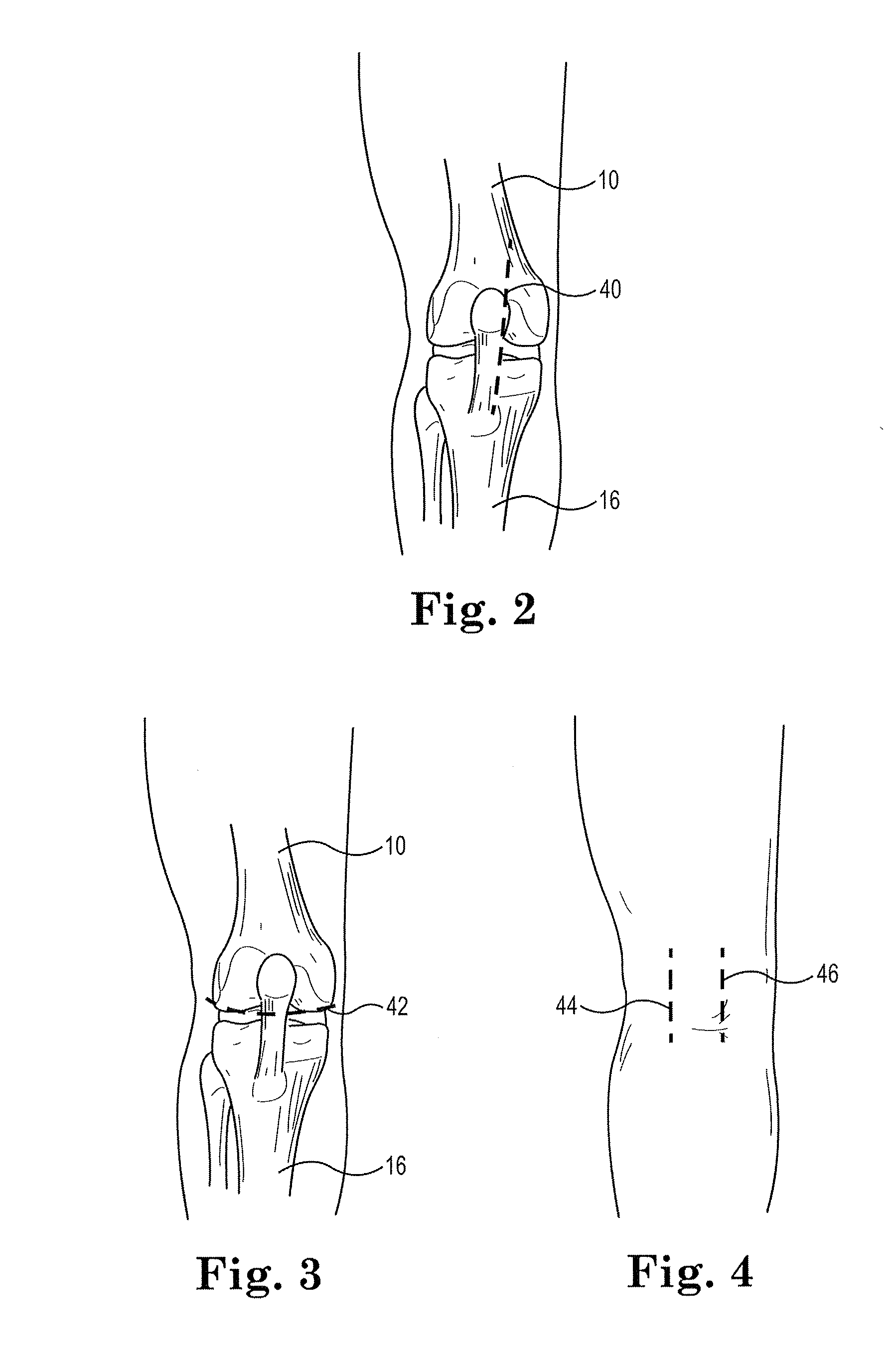 Modular apparatus and method for sculpting the surface of a joint