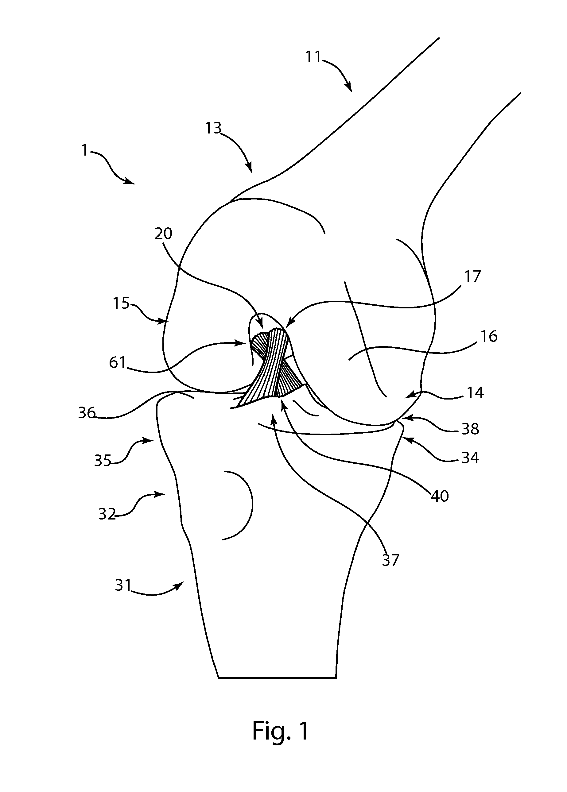 Double bundle ACL repair system