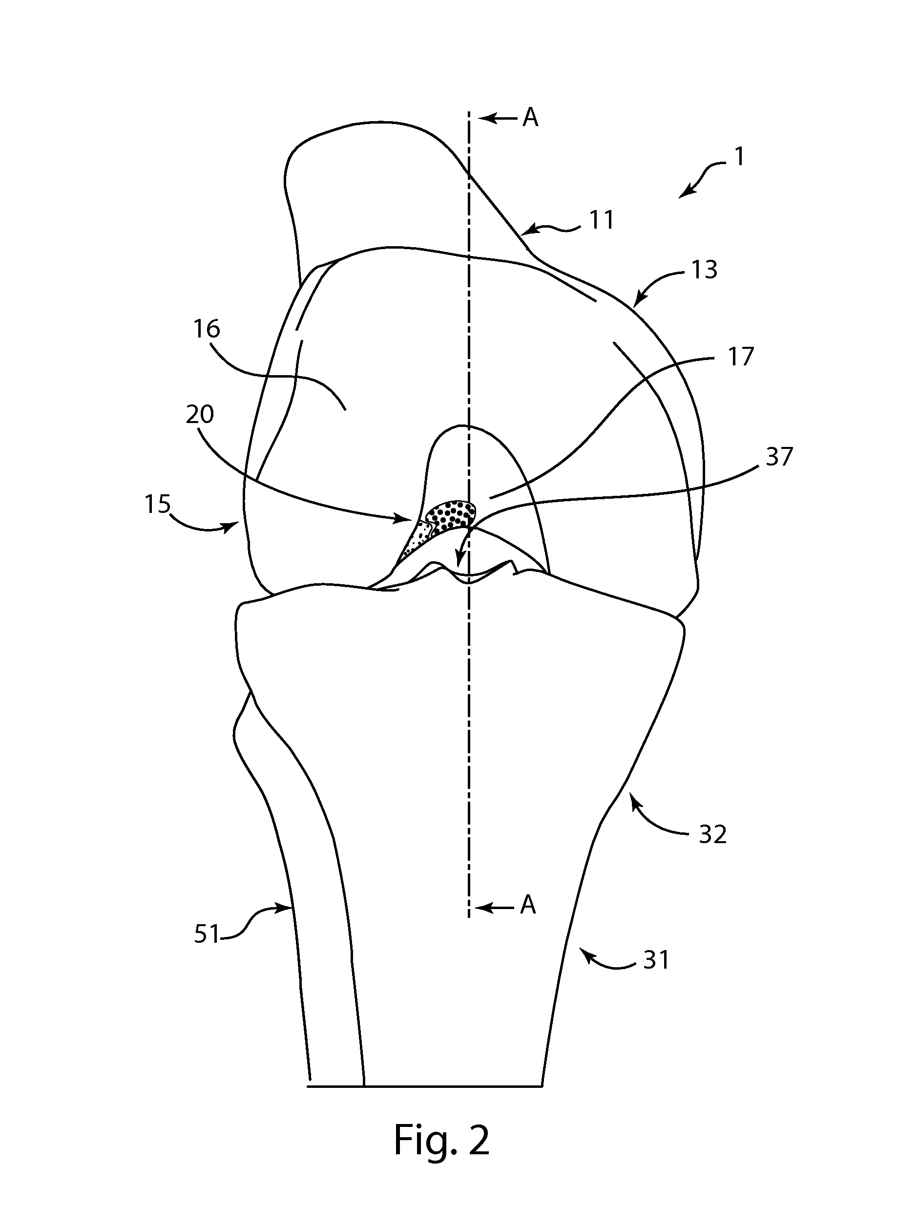 Double bundle ACL repair system