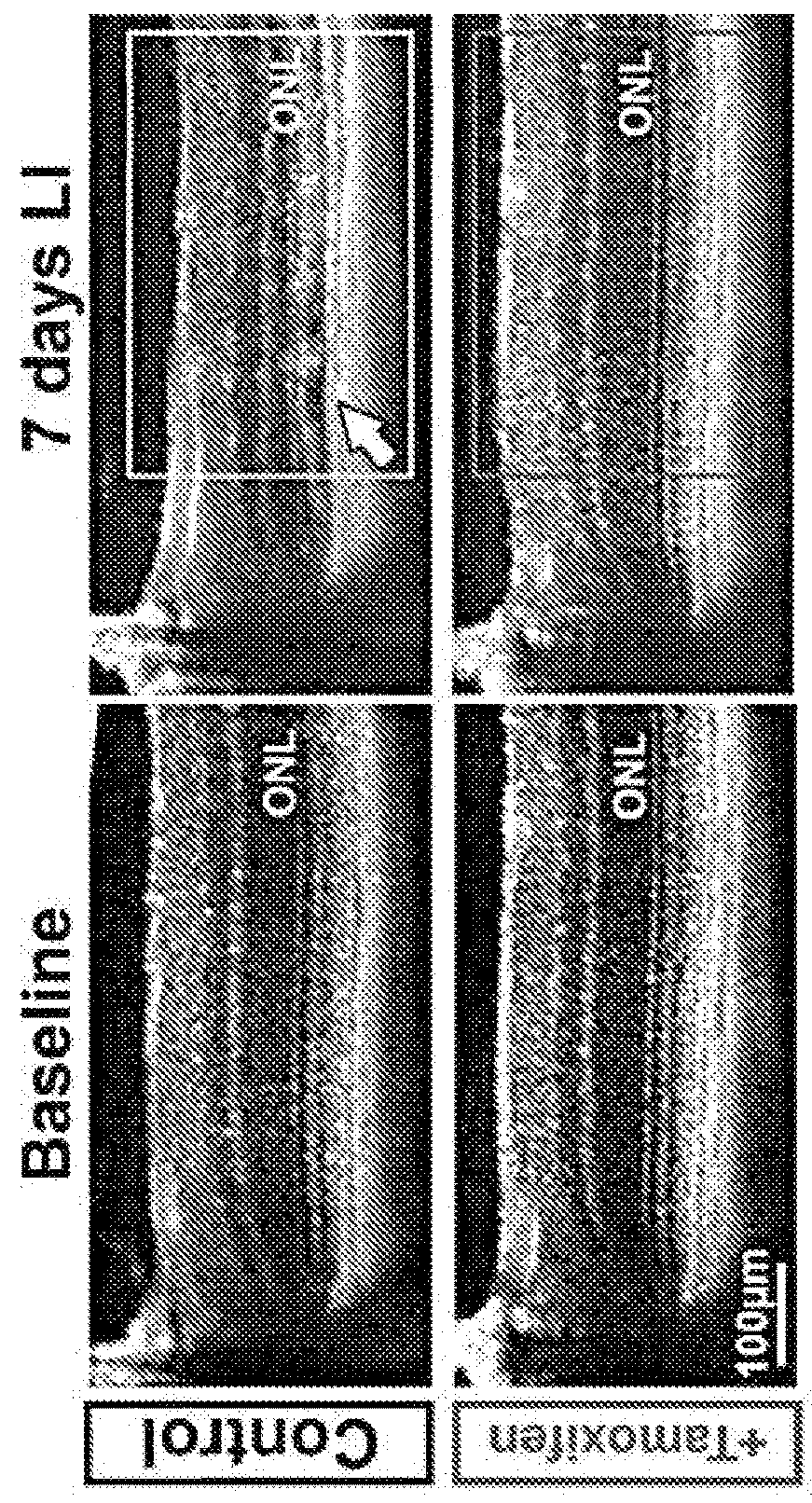 Selective estrogen-receptor modulators (SERMS) confer protection against photoreceptor degeneration