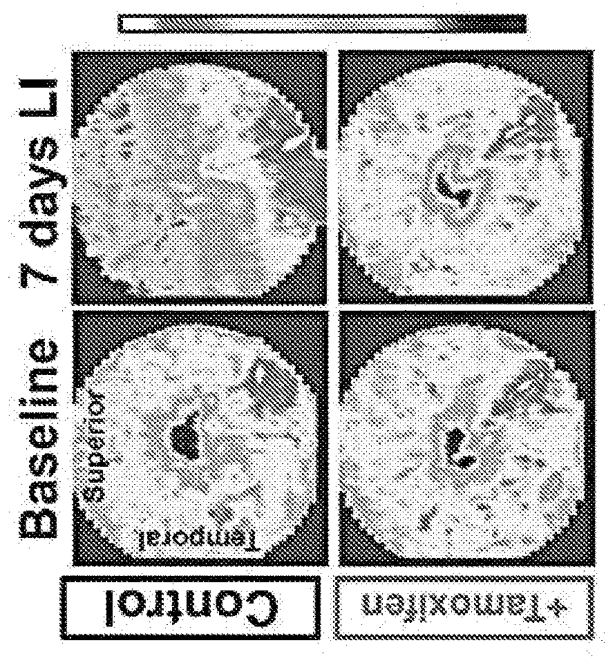 Selective estrogen-receptor modulators (SERMS) confer protection against photoreceptor degeneration