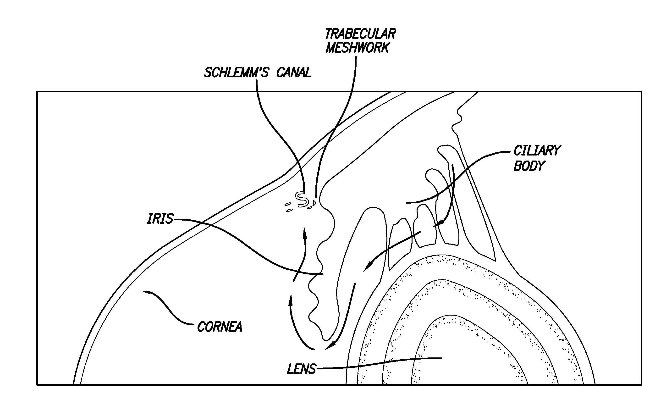 Ultrasonic treatment of glaucoma