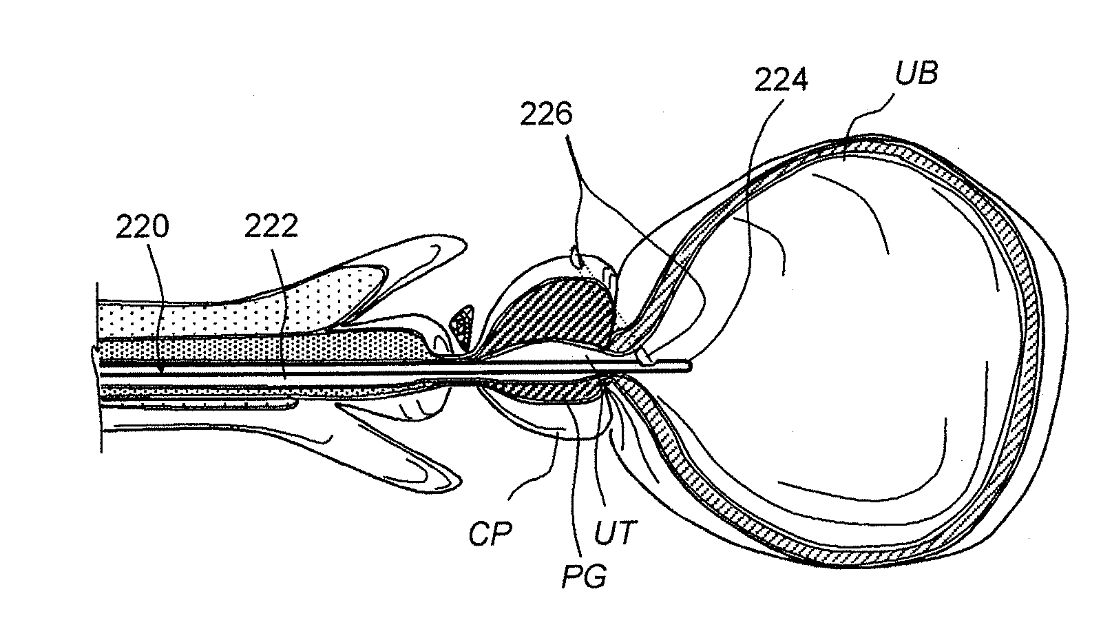 Devices, systems and methods for treating benign prostatic hyperplasia and other conditions