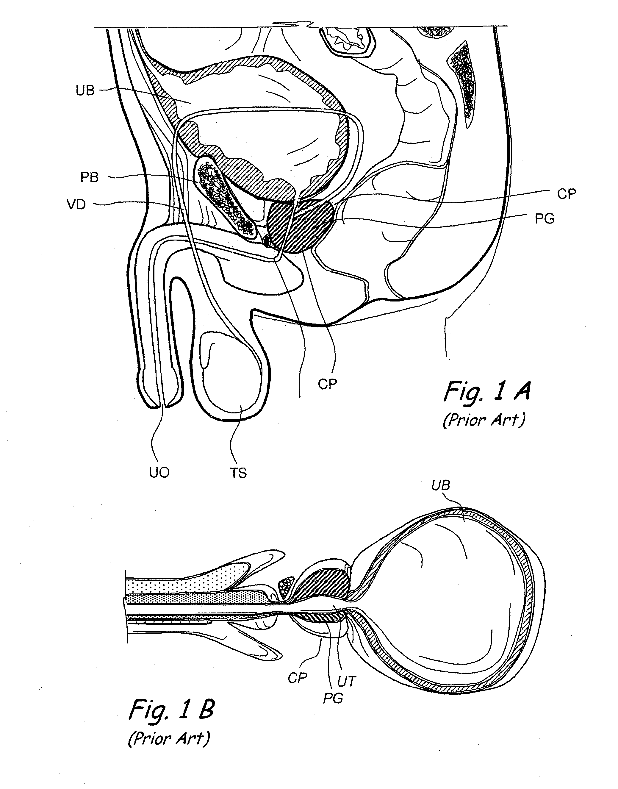 Devices, systems and methods for treating benign prostatic hyperplasia and other conditions