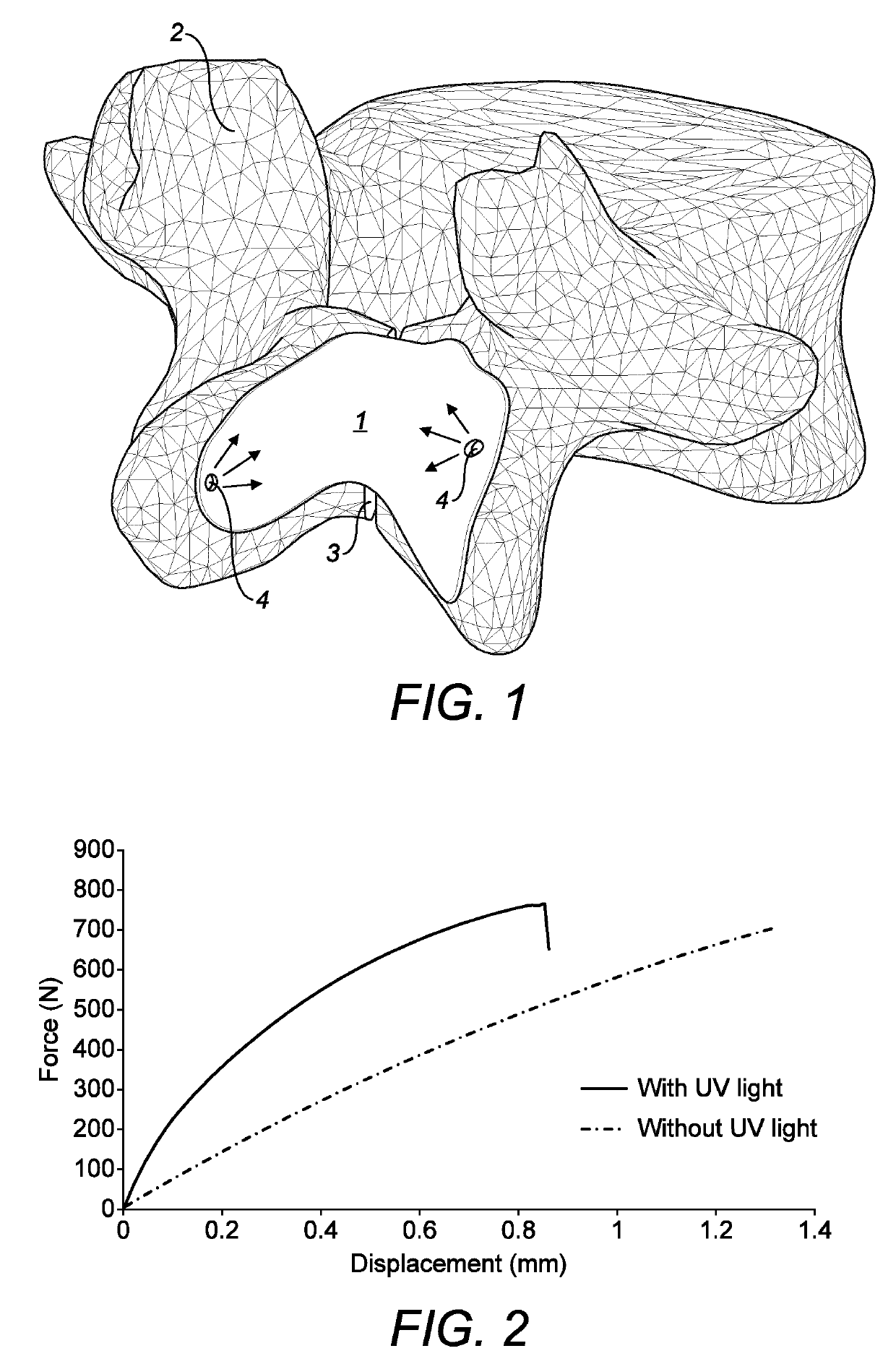 Bone implant