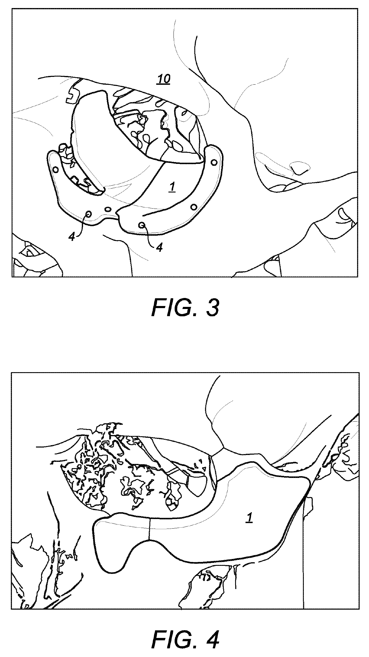 Bone implant