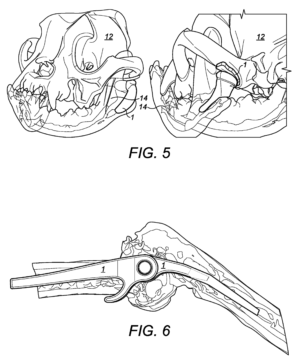 Bone implant