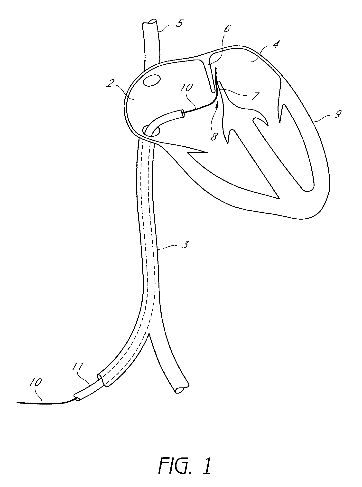 Suturing Devices and Methods for Closing a Patent Foramen Ovale