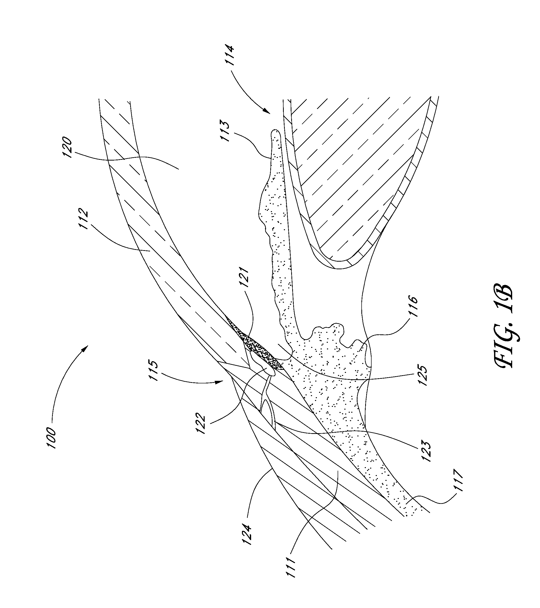 System and method for delivering multiple ocular implants