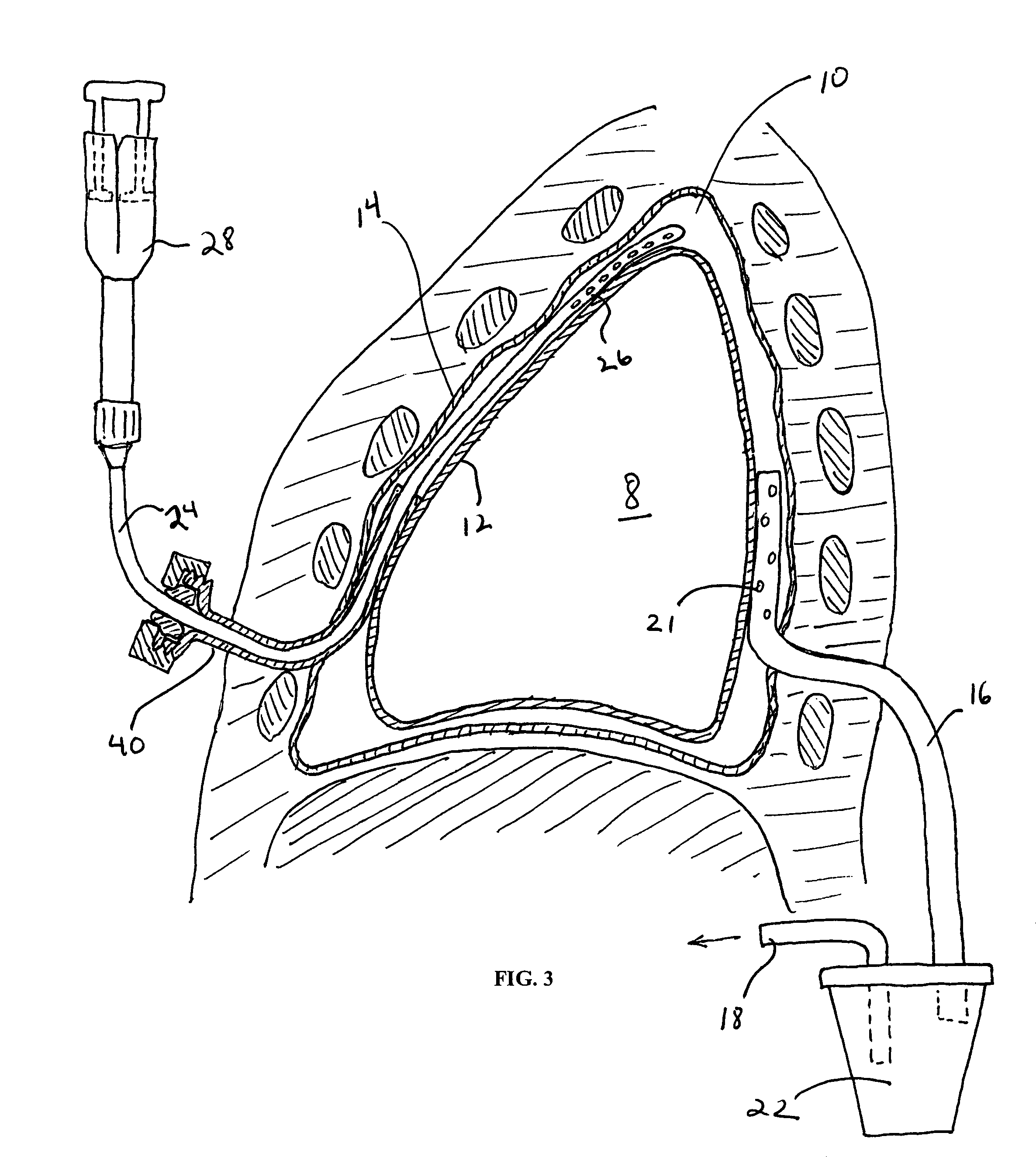 Pleural effusion treatment device, method and material