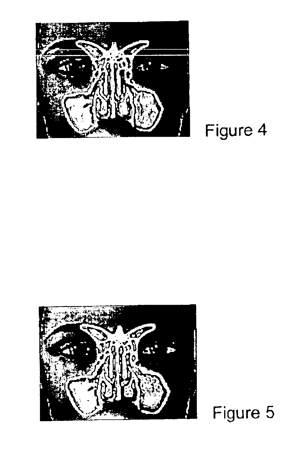 Methods for treating sinus headache