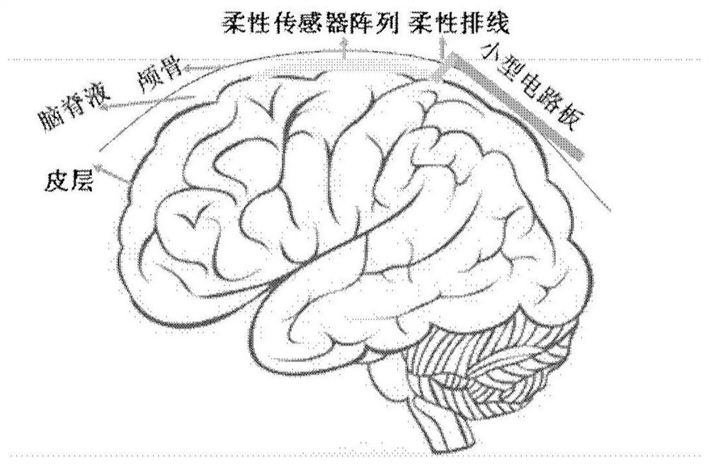 Brain disease judgment system based on intracranial multi-modal information fusion of machine learning