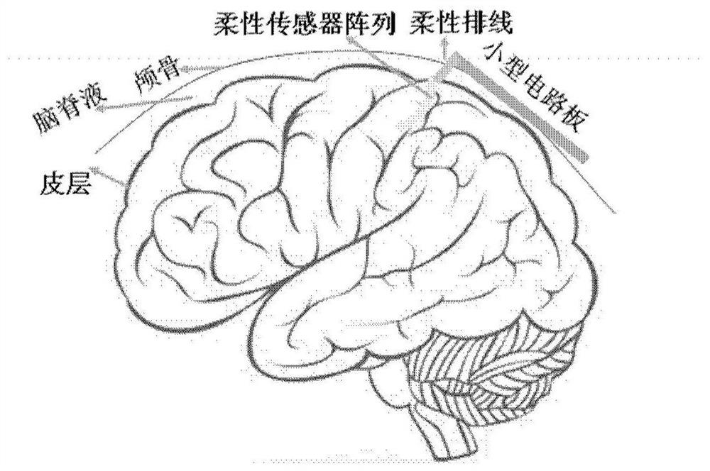 Brain disease judgment system based on intracranial multi-modal information fusion of machine learning