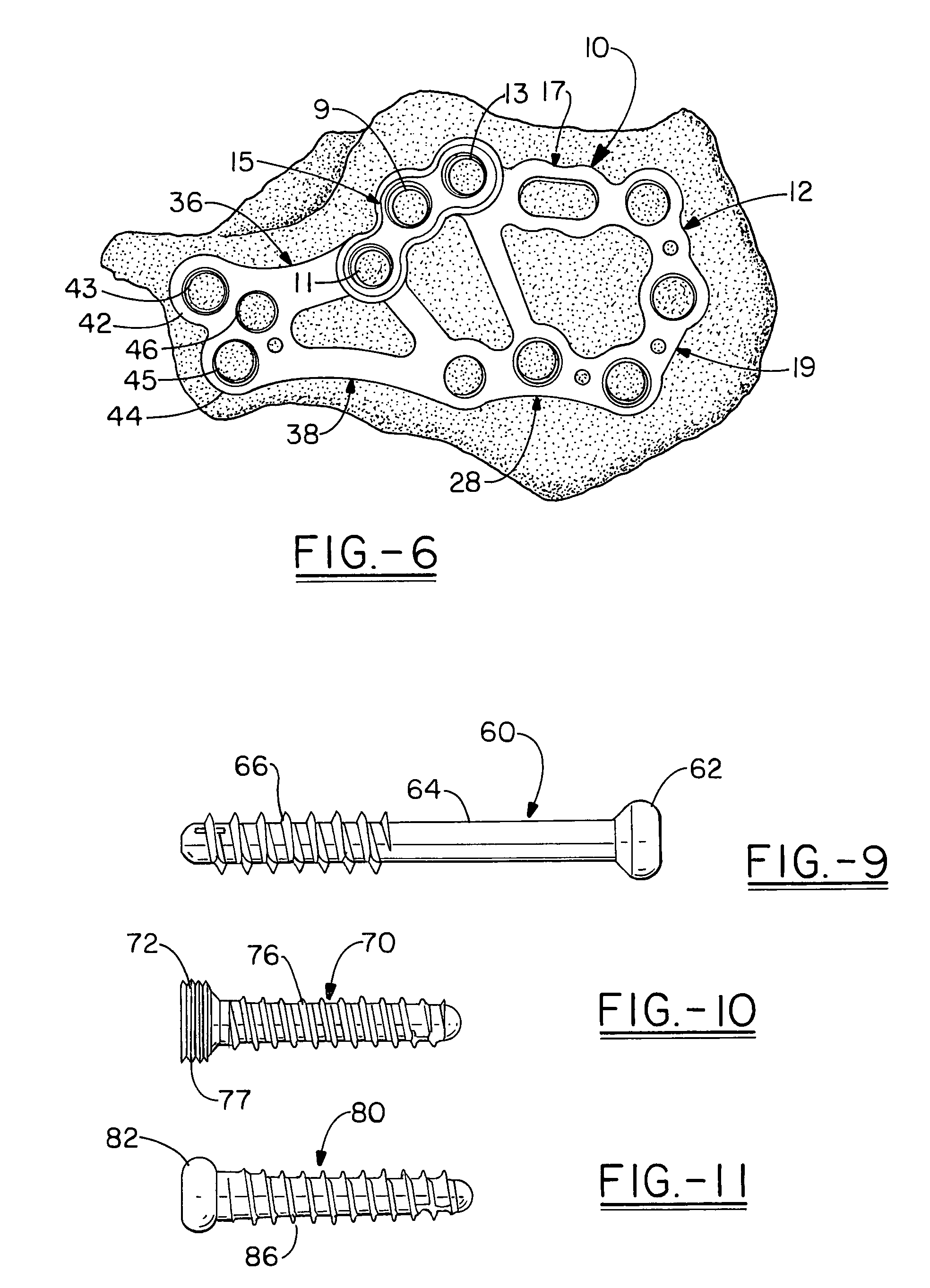 Calcaneal plate