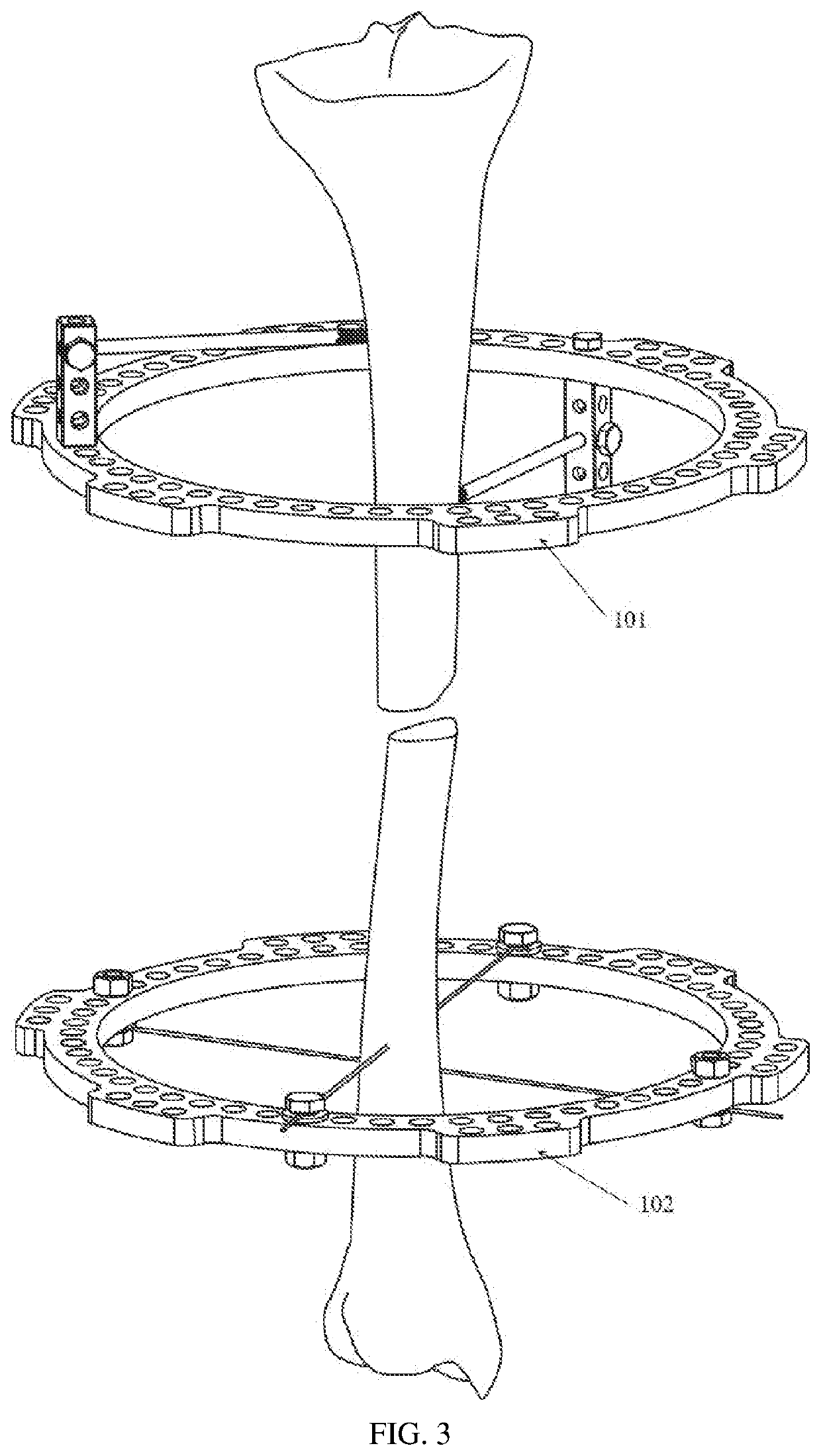 Fracture reduction method and parallel external fixator for fracture reduction