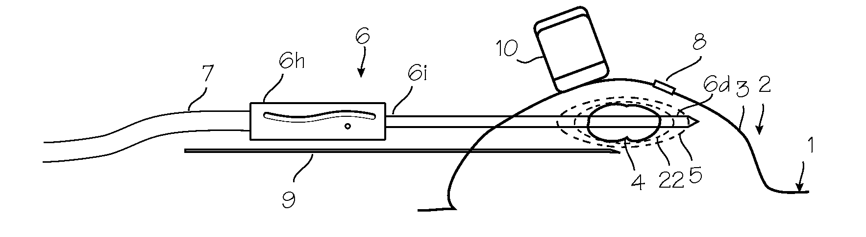 Cryosurgical System with Low Pressure Cryogenic Fluid Supply