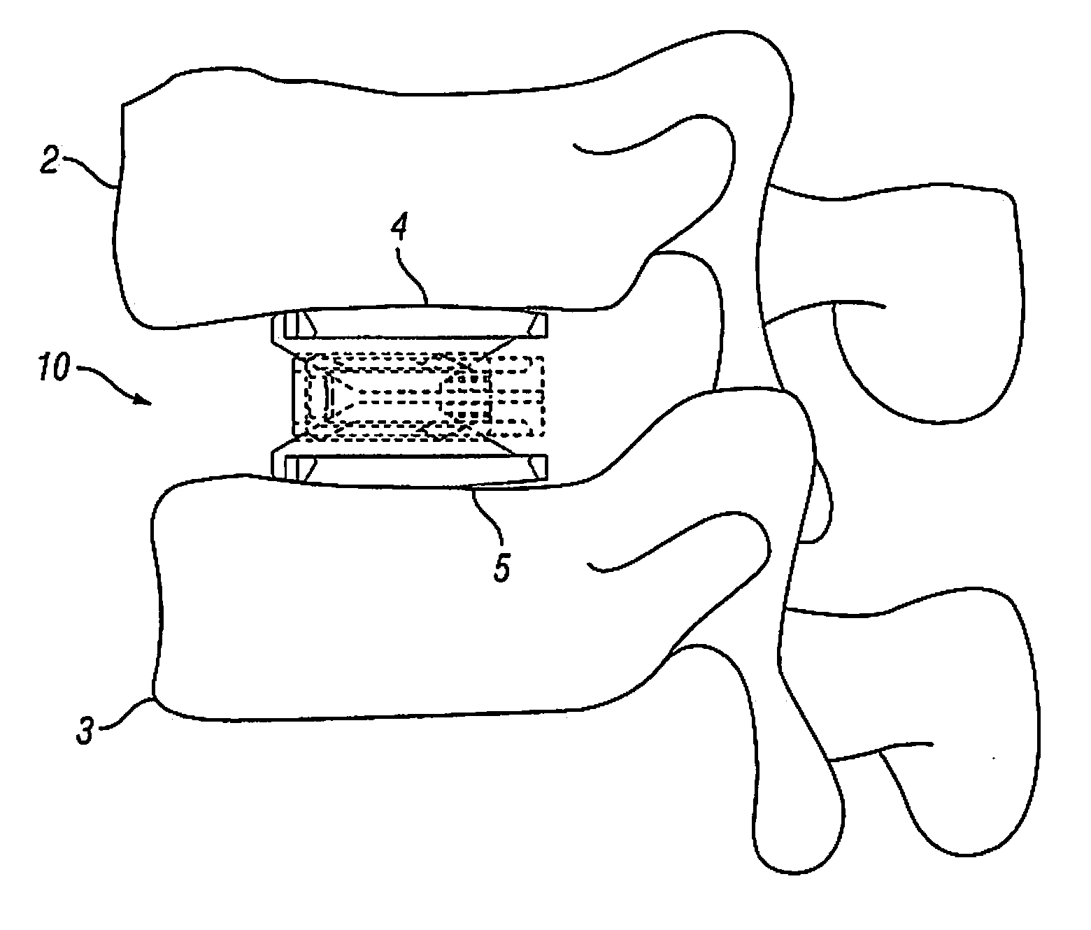 Expandable Fusion Device and Method of Installation Thereof