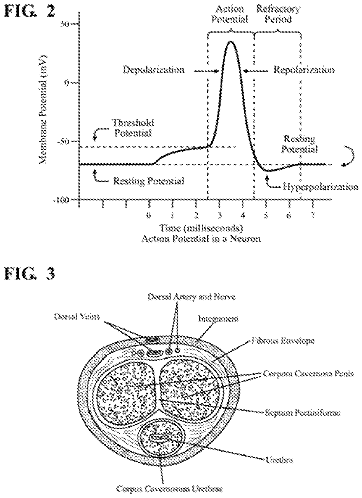 Detection and treatment of obstructive sleep apnea