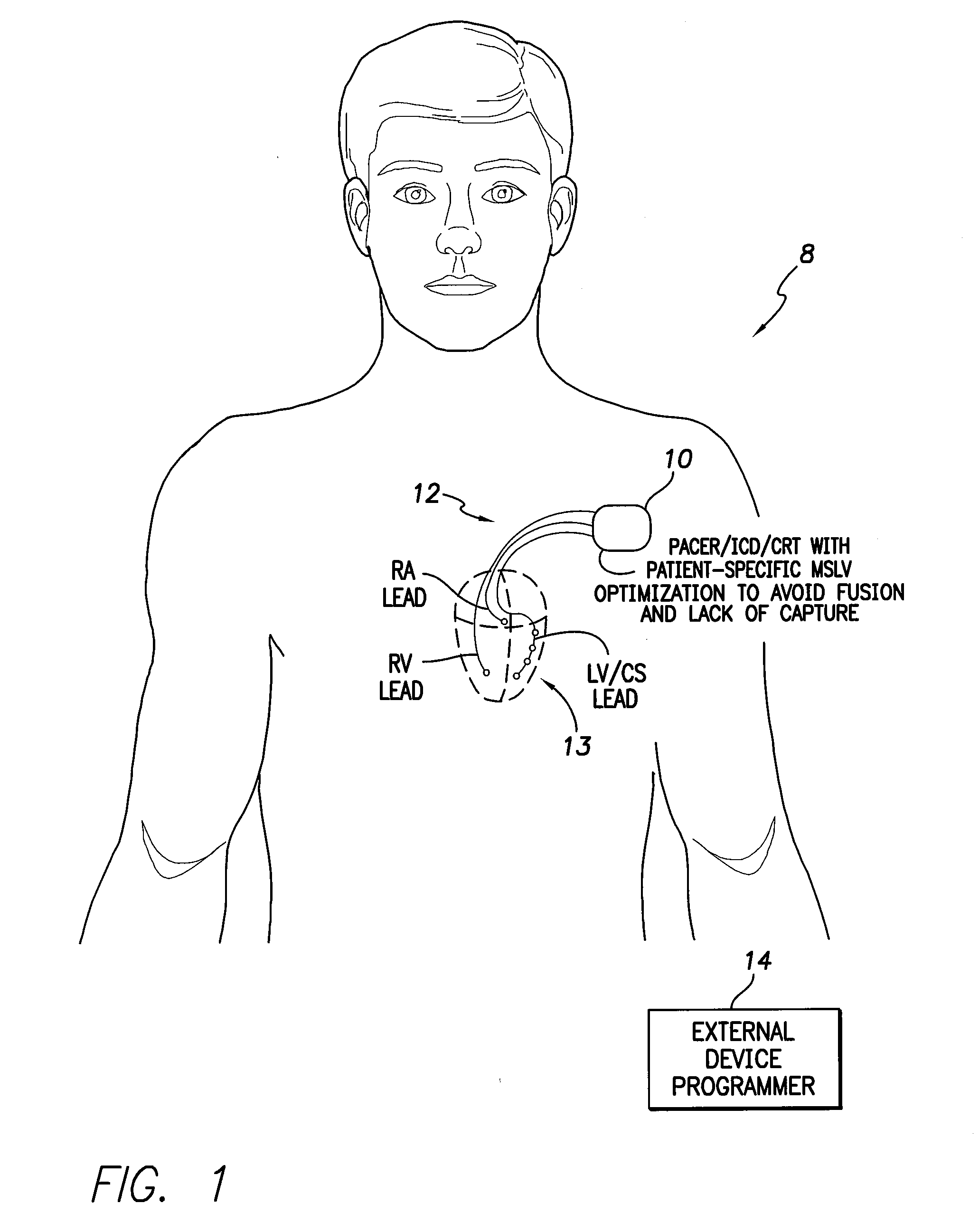 Systems and methods for selectively limiting multi-site ventricular pacing delays during optimization of cardiac resynchronization therapy parameters