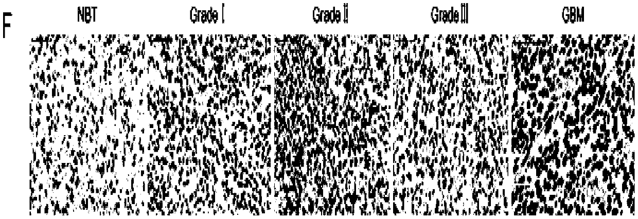 Application of TMSB10 in diagnosis and treatment of glioma