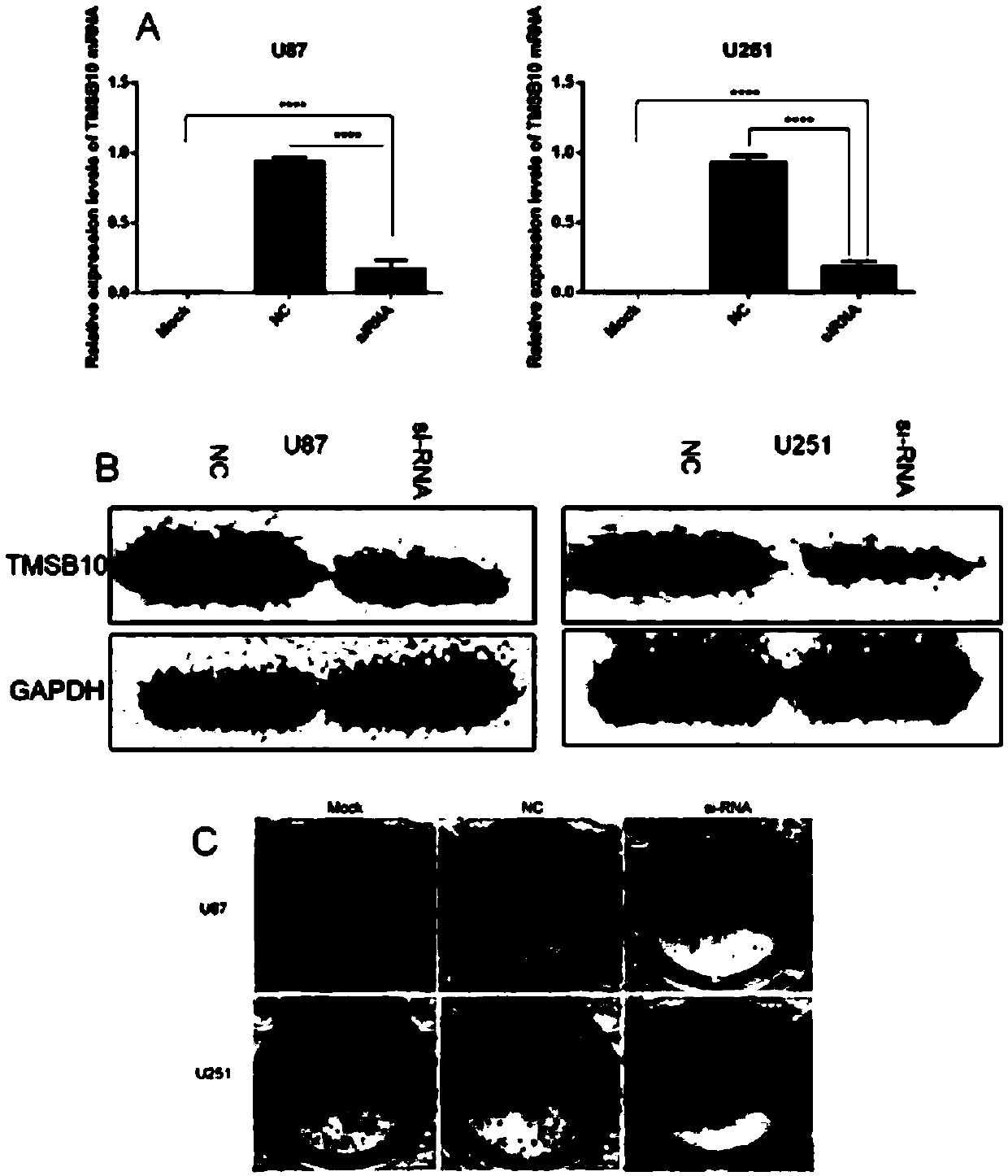 Application of TMSB10 in diagnosis and treatment of glioma