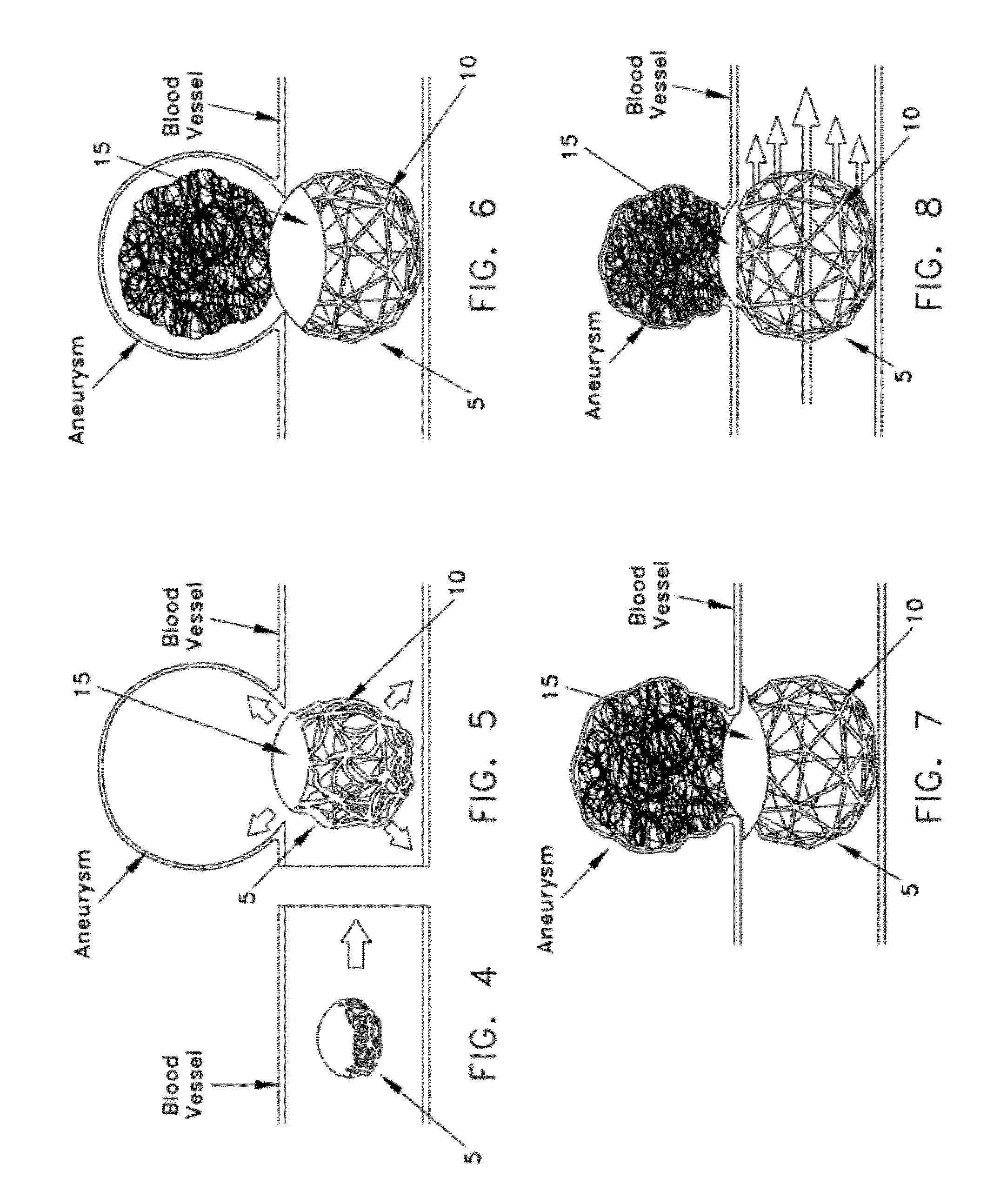 Method and apparatus for restricting flow through an opening in the side wall of a body lumen, and/or for reinforcing a weakness in the side wall of a body lumen, while still maintaining substantially normal flow through the body lumen