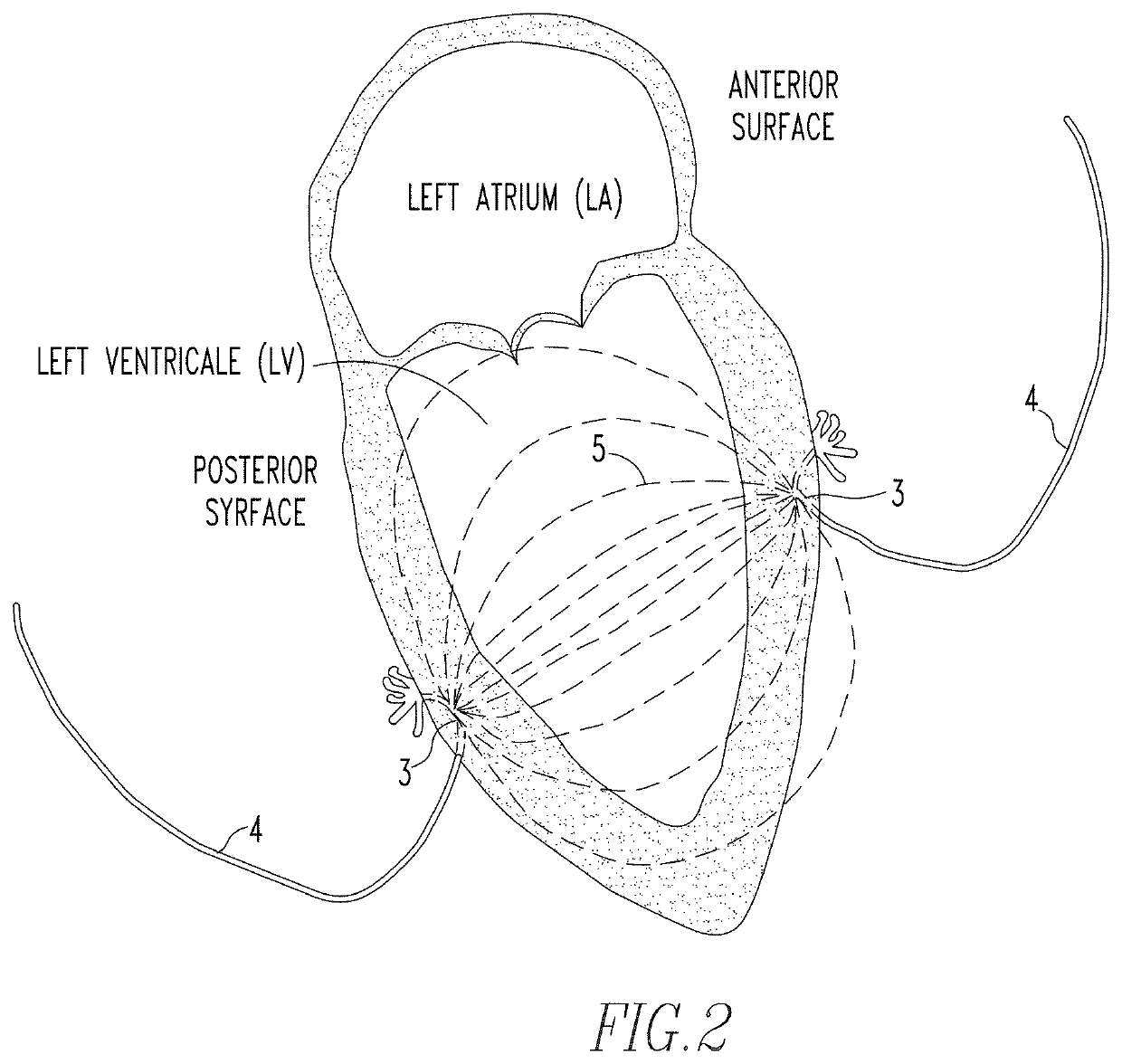 Method and apparatus for monitoring a patient