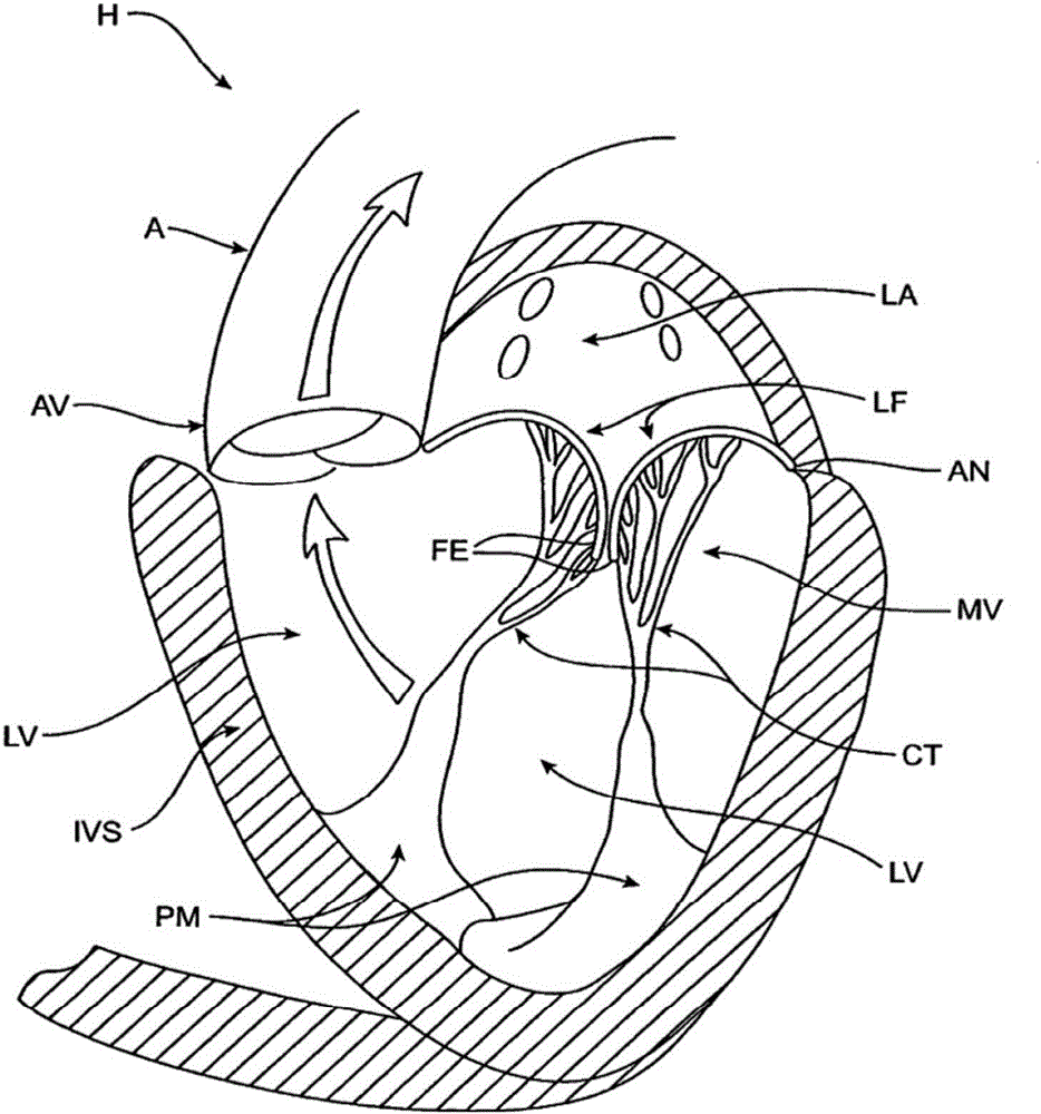 Sequentially deployed transcatheter mitral valve prosthesis