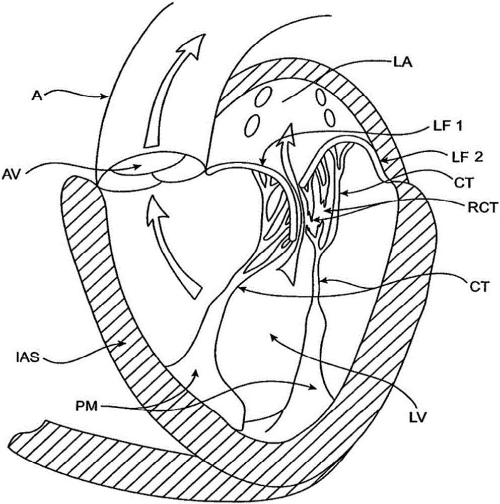 Sequentially deployed transcatheter mitral valve prosthesis