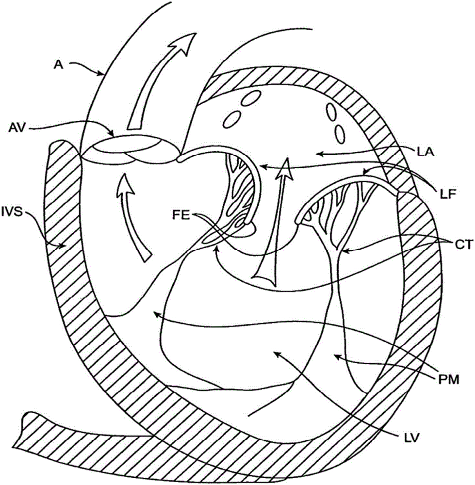 Sequentially deployed transcatheter mitral valve prosthesis