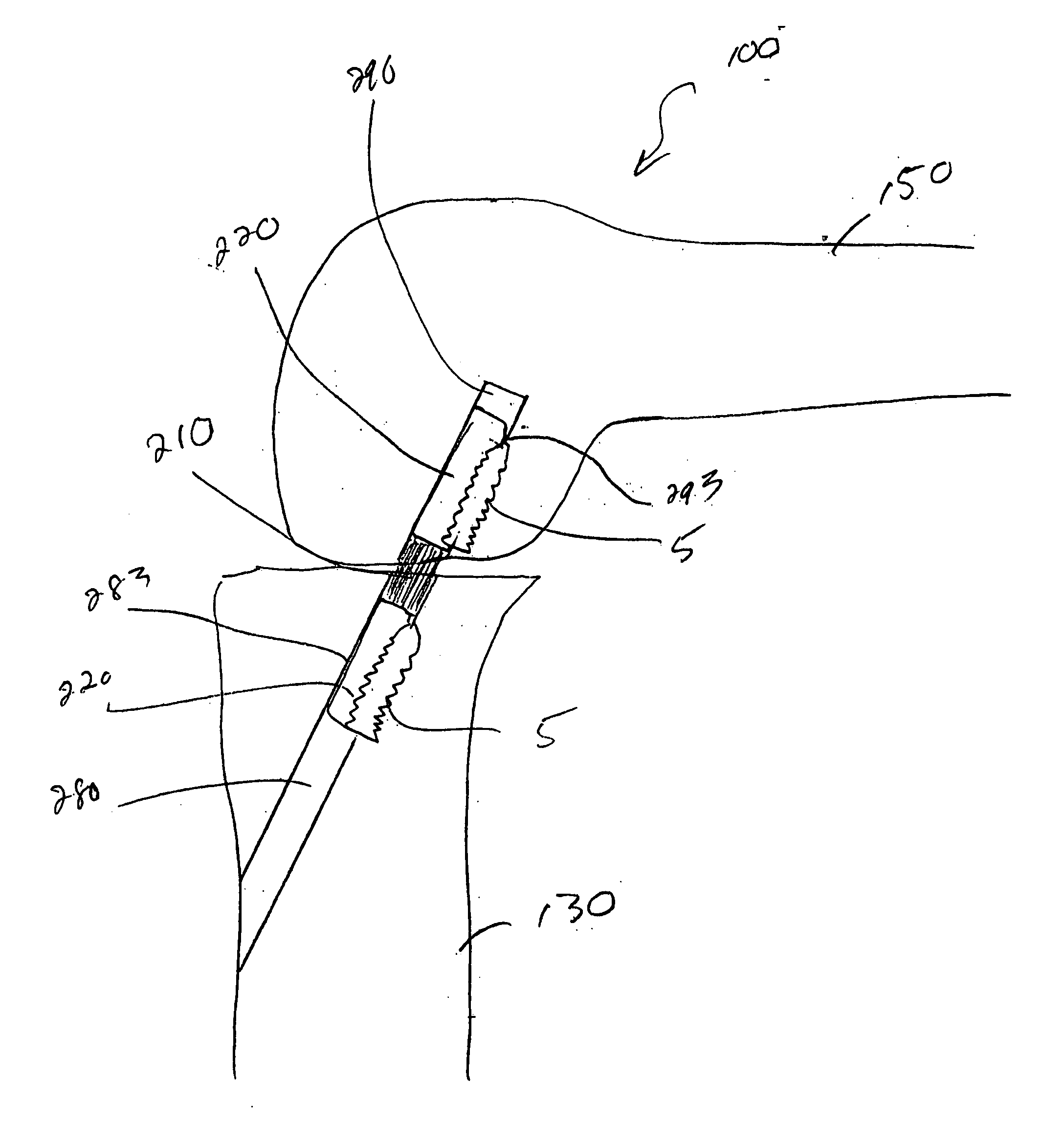 Method of performing anterior cruciate ligament reconstruction using biodegradable interference screw