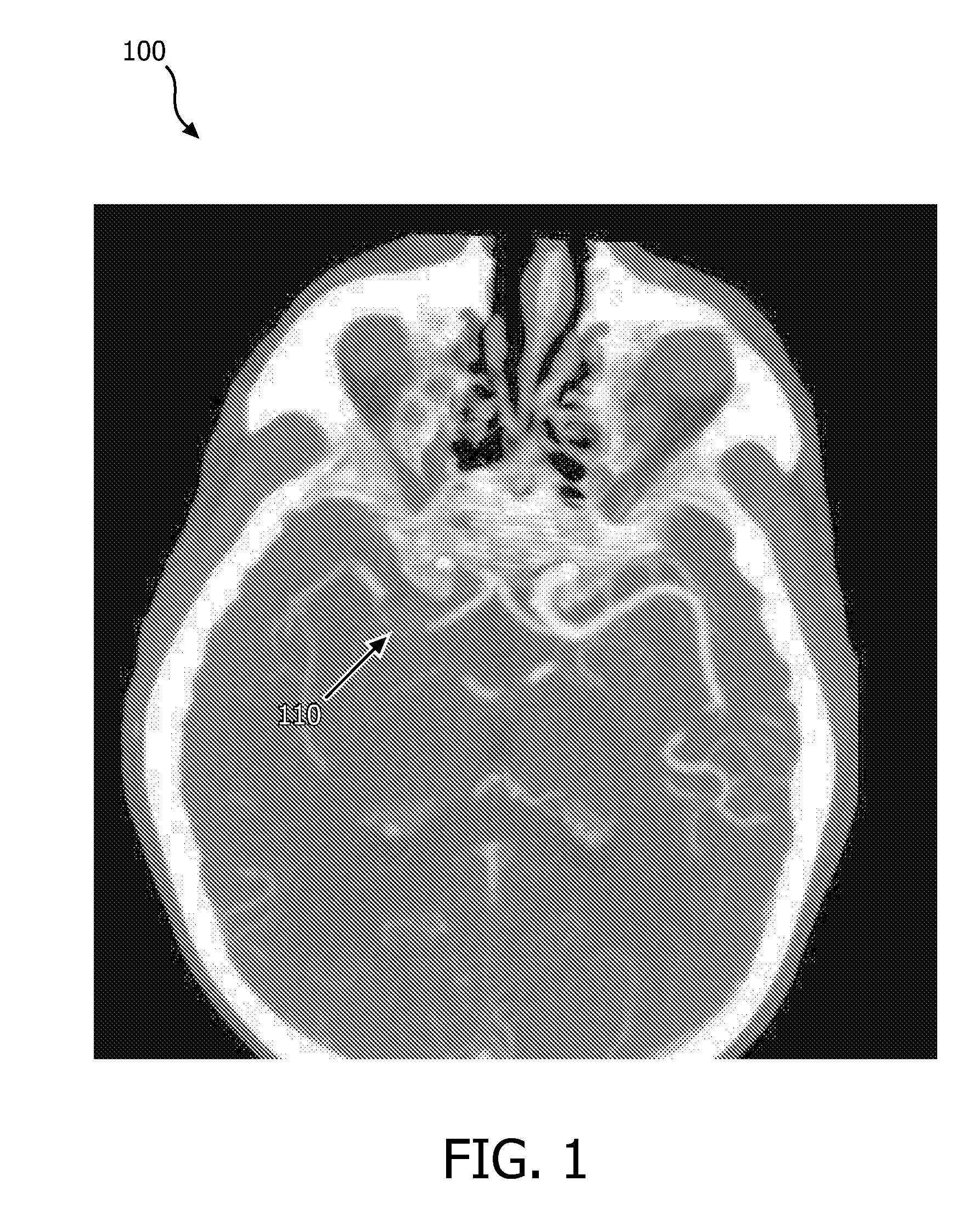 System and method for ultrasound and computed tomography image registration for sonothrombolysis treatment