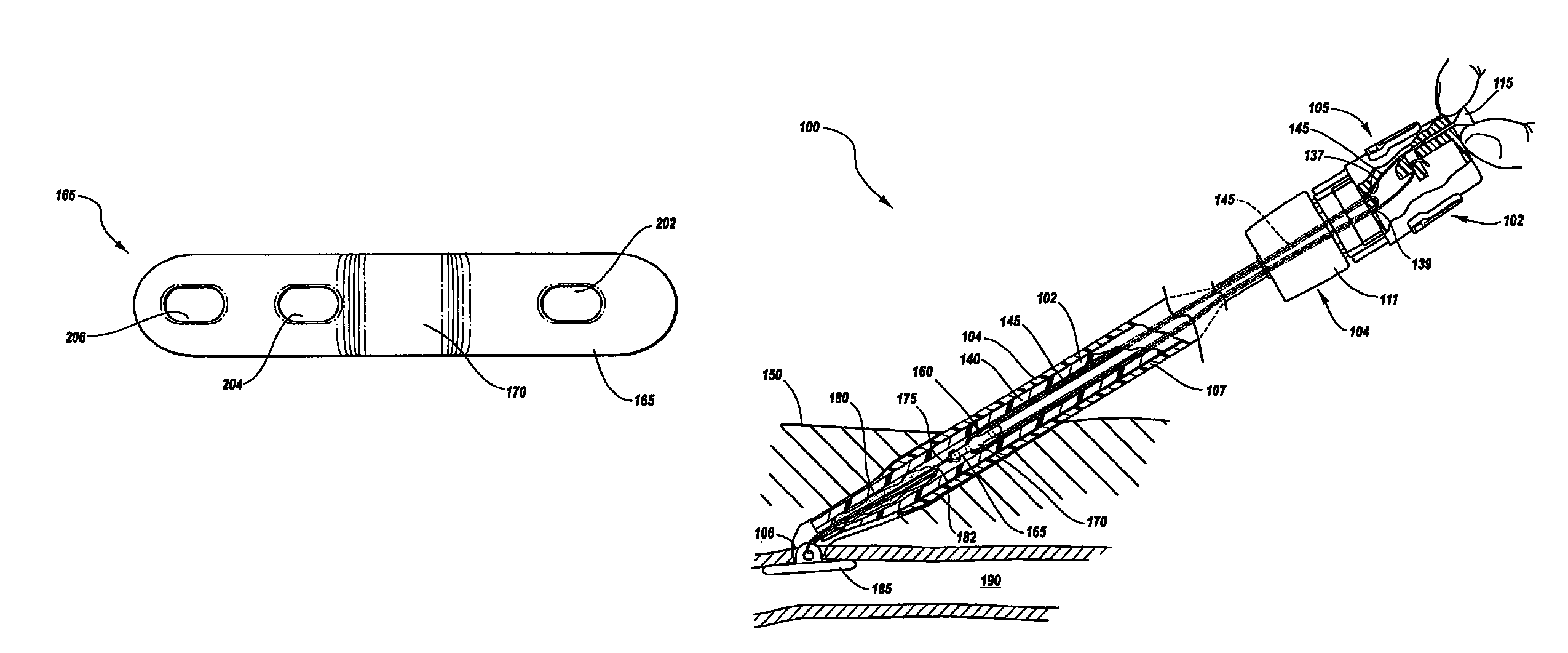 Method and apparatus for sealing an internal tissue puncture incorporating a block and tackle