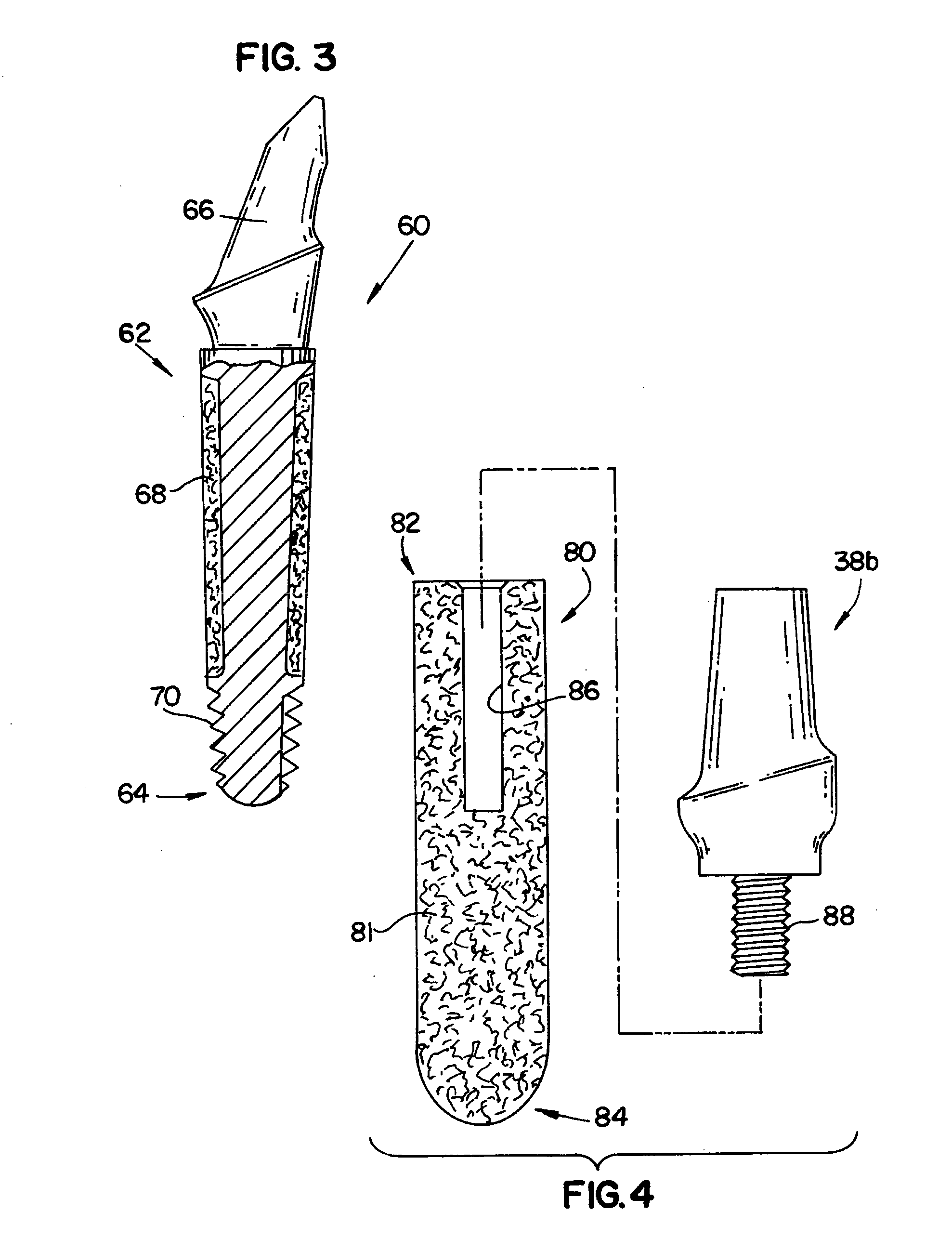 Dental implant for a jaw with reduced bone volume and improved osseointegration features