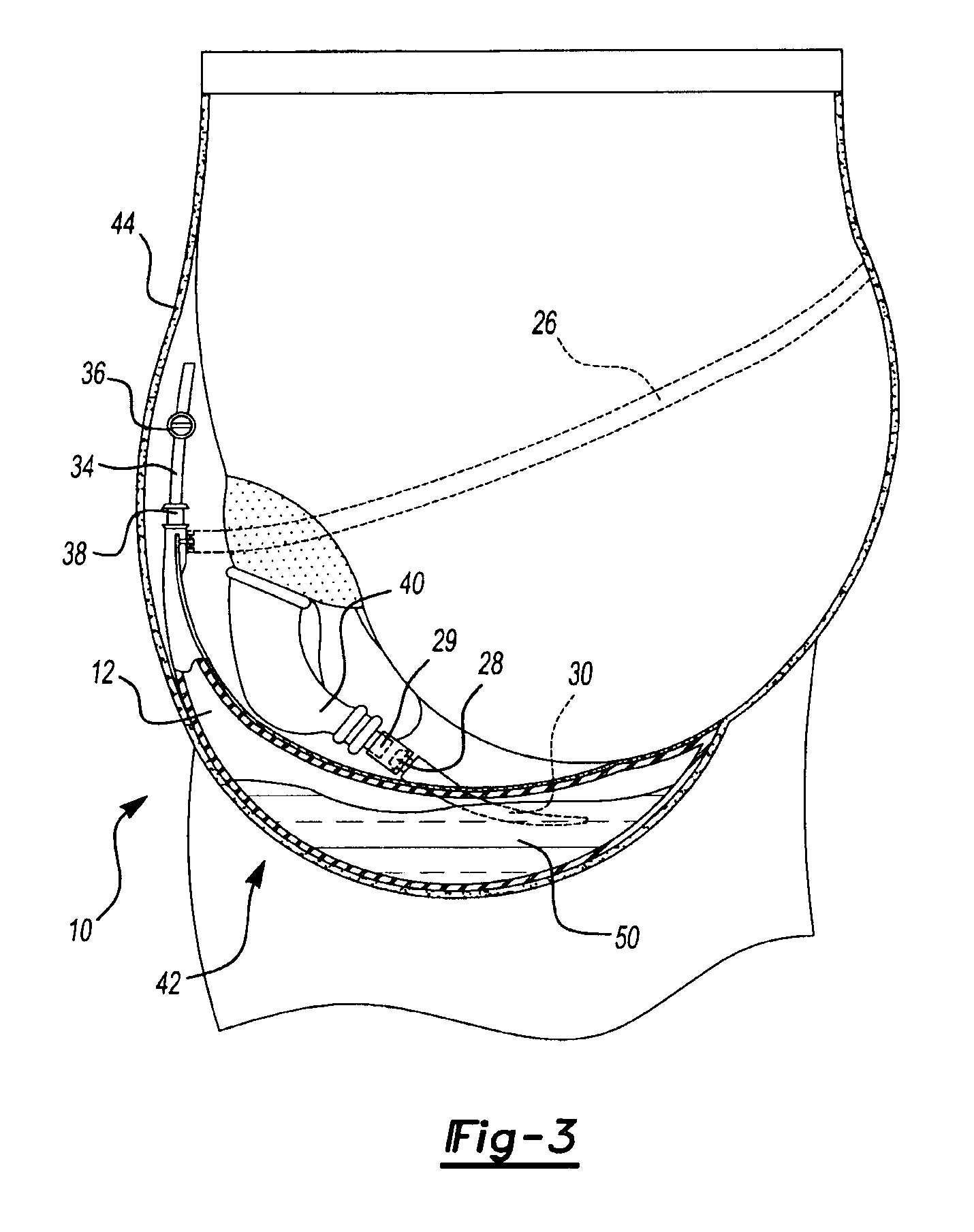 Closed coupled urine collection chamber