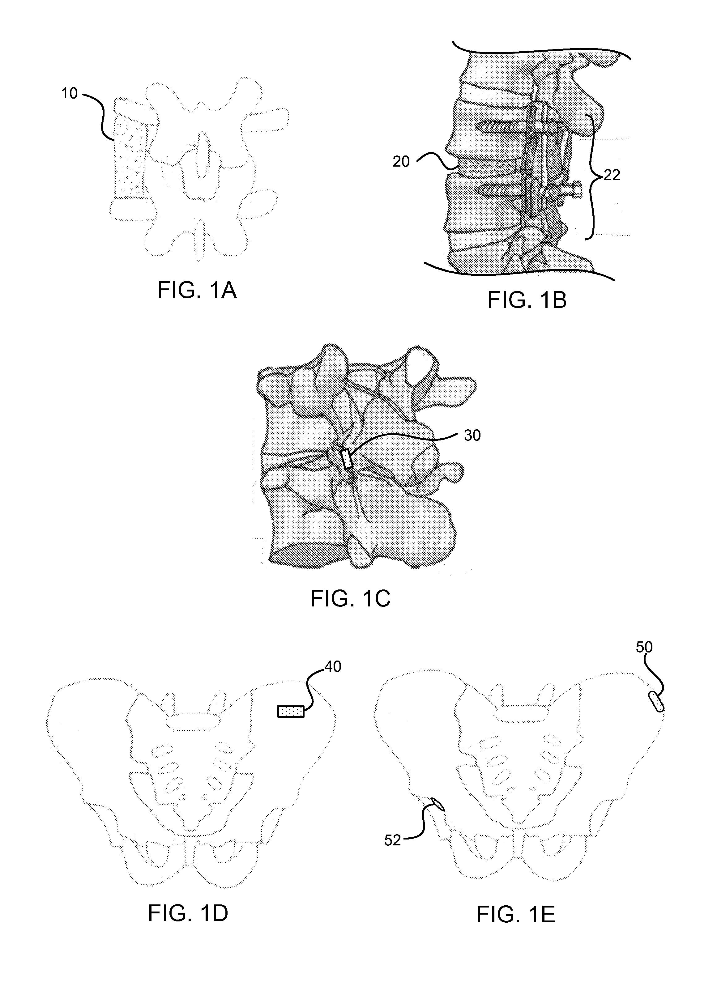 Bone graft materials and methods