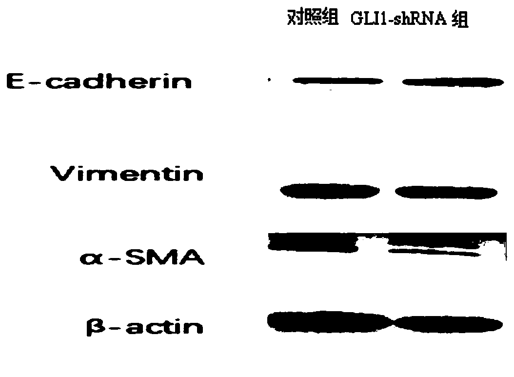 GLI1-shRNA and application thereof