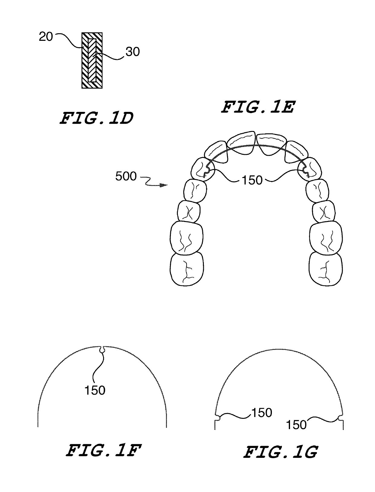 Orthodontic wire alignment system and method