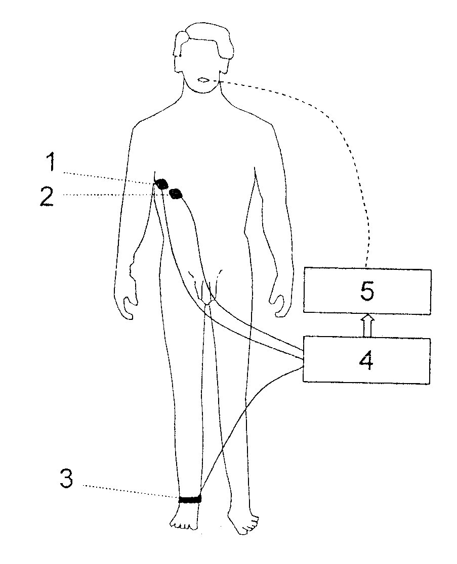 Method of automatically controlling a respiration system and a corresponding respirator