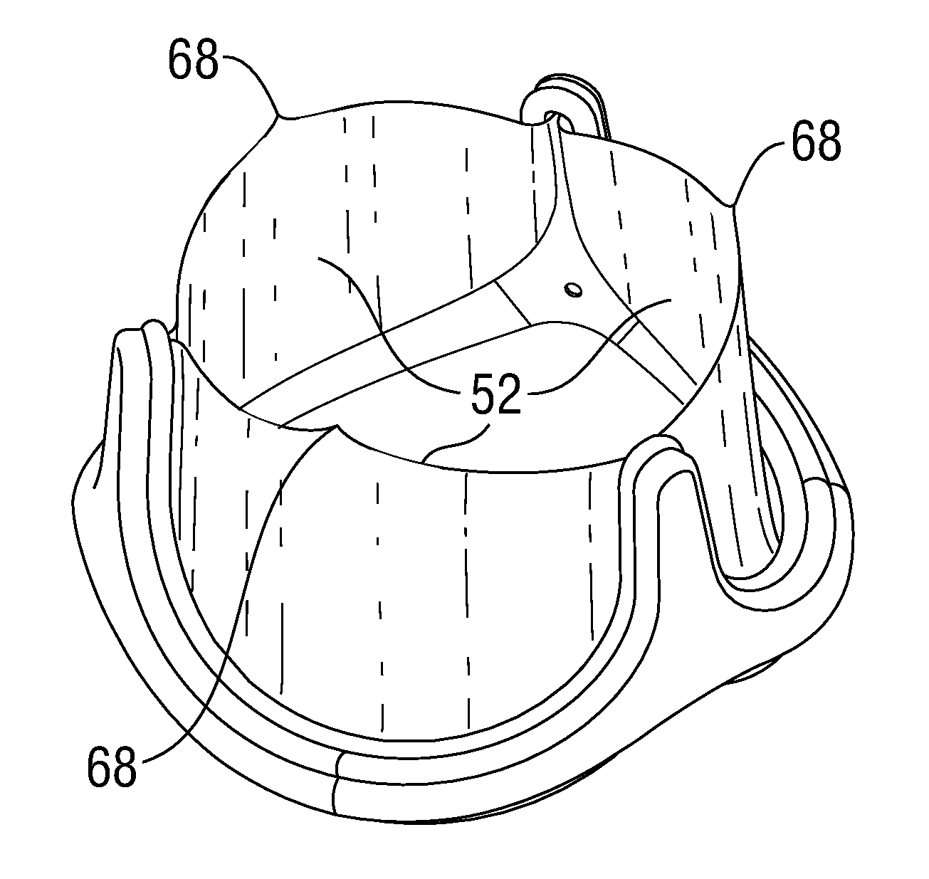 Low Gradient Prosthetic Heart Valve