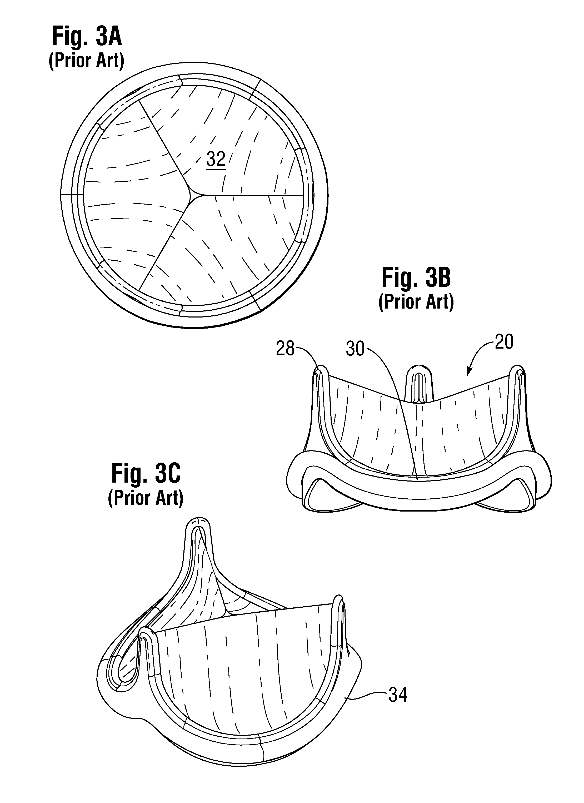 Low Gradient Prosthetic Heart Valve