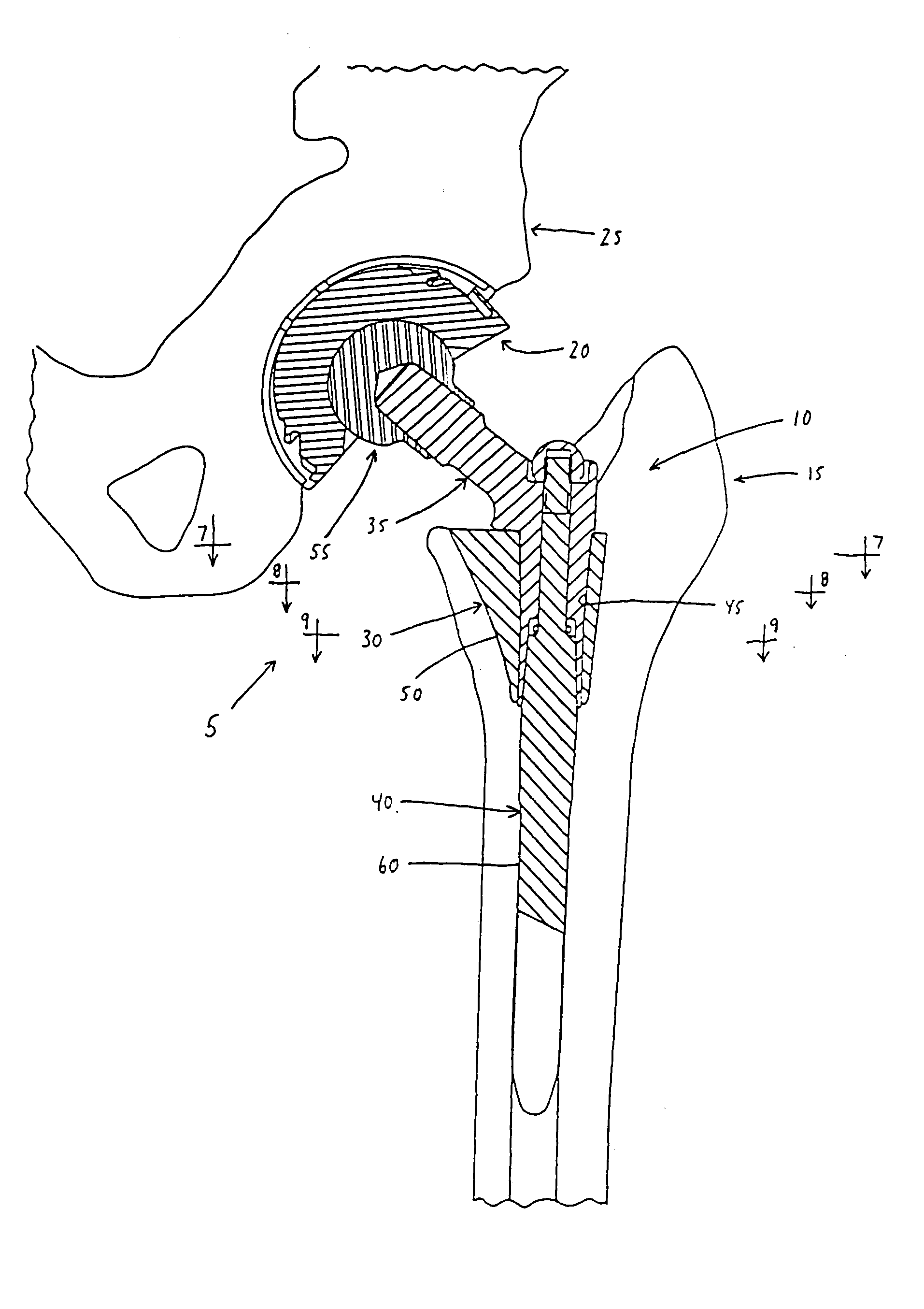 Modular prosthetic component with improved body shape