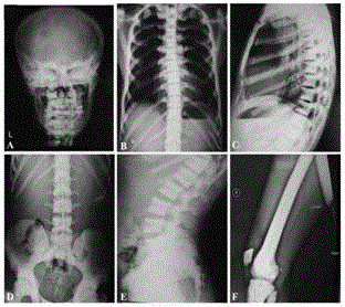 Novel mutant pathogenic gene PLEKHM1 of osteopetrosis, and encoded protein and application thereof