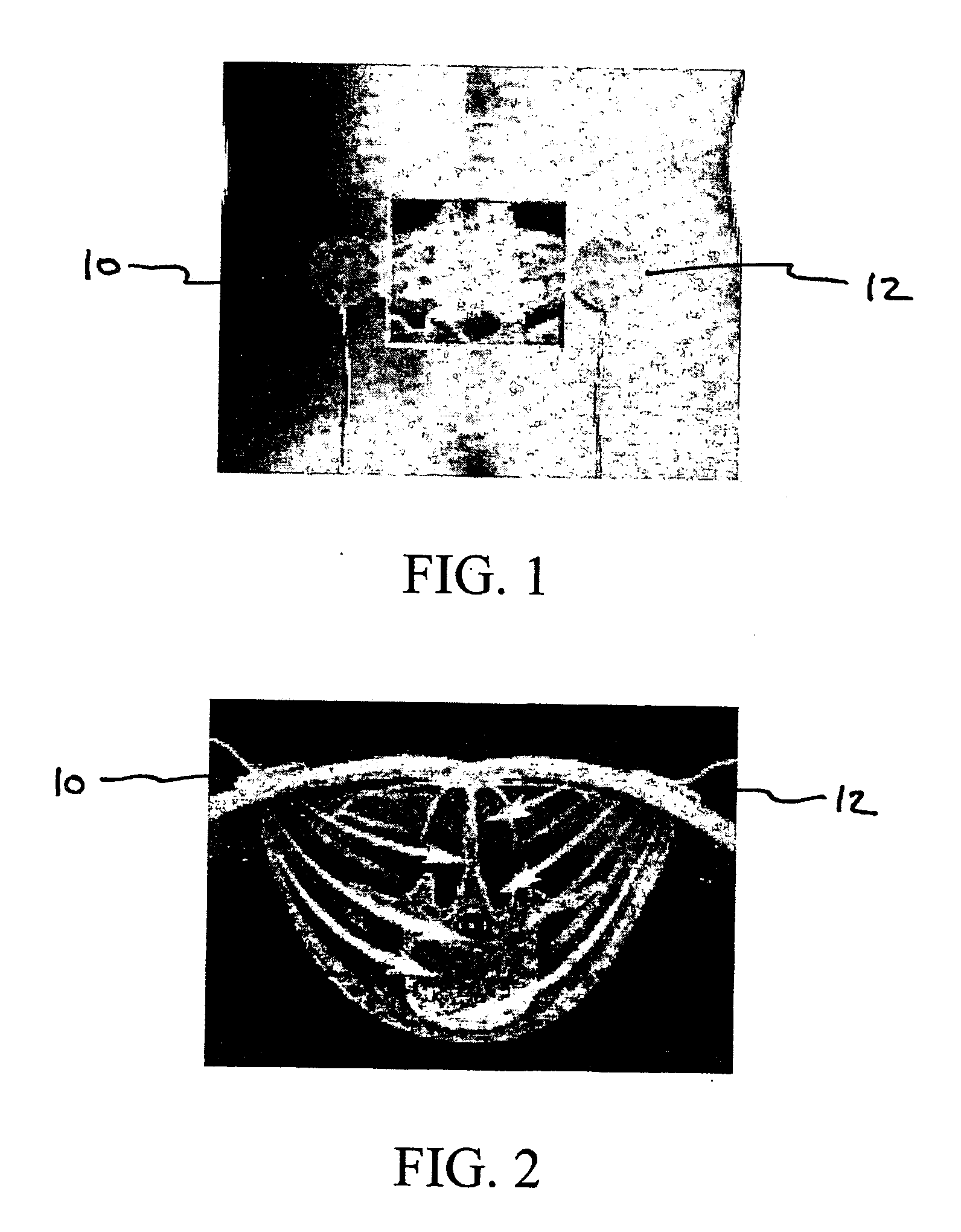 Method for treating degenerative disc disease using noninvasive capacitively coupled electrical stimulation device