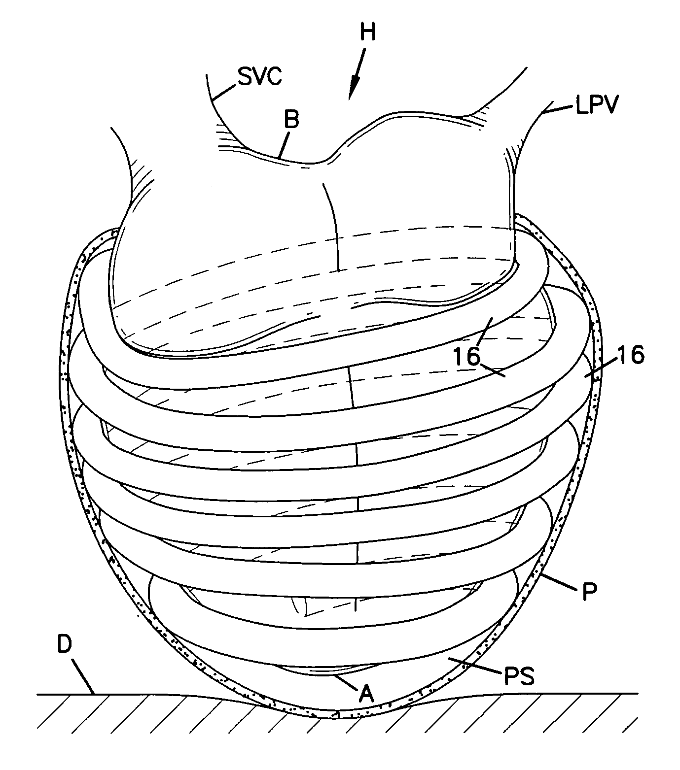 Transmyocardial delivery of cardiac wall tension relief